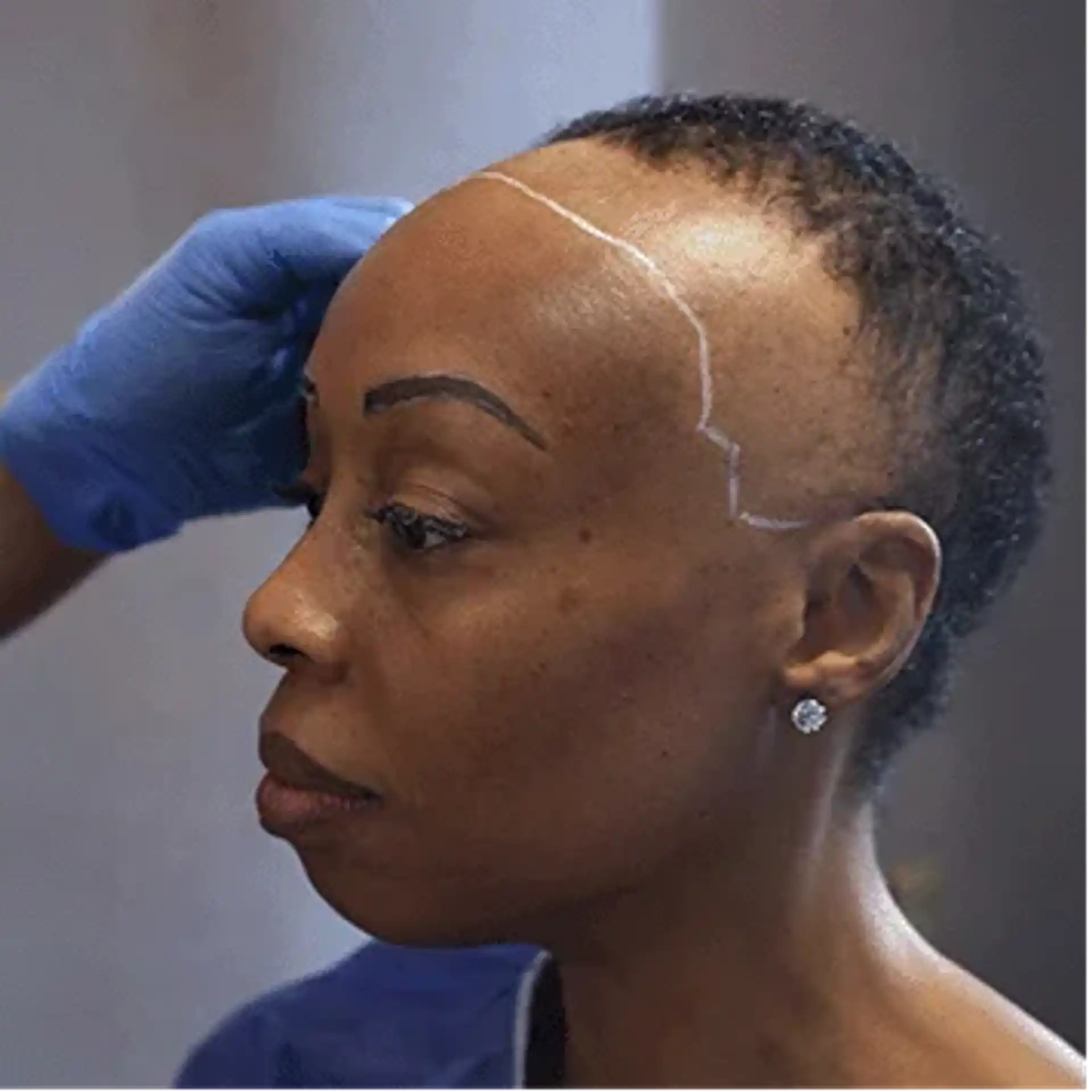 Frauen Haartransplantation