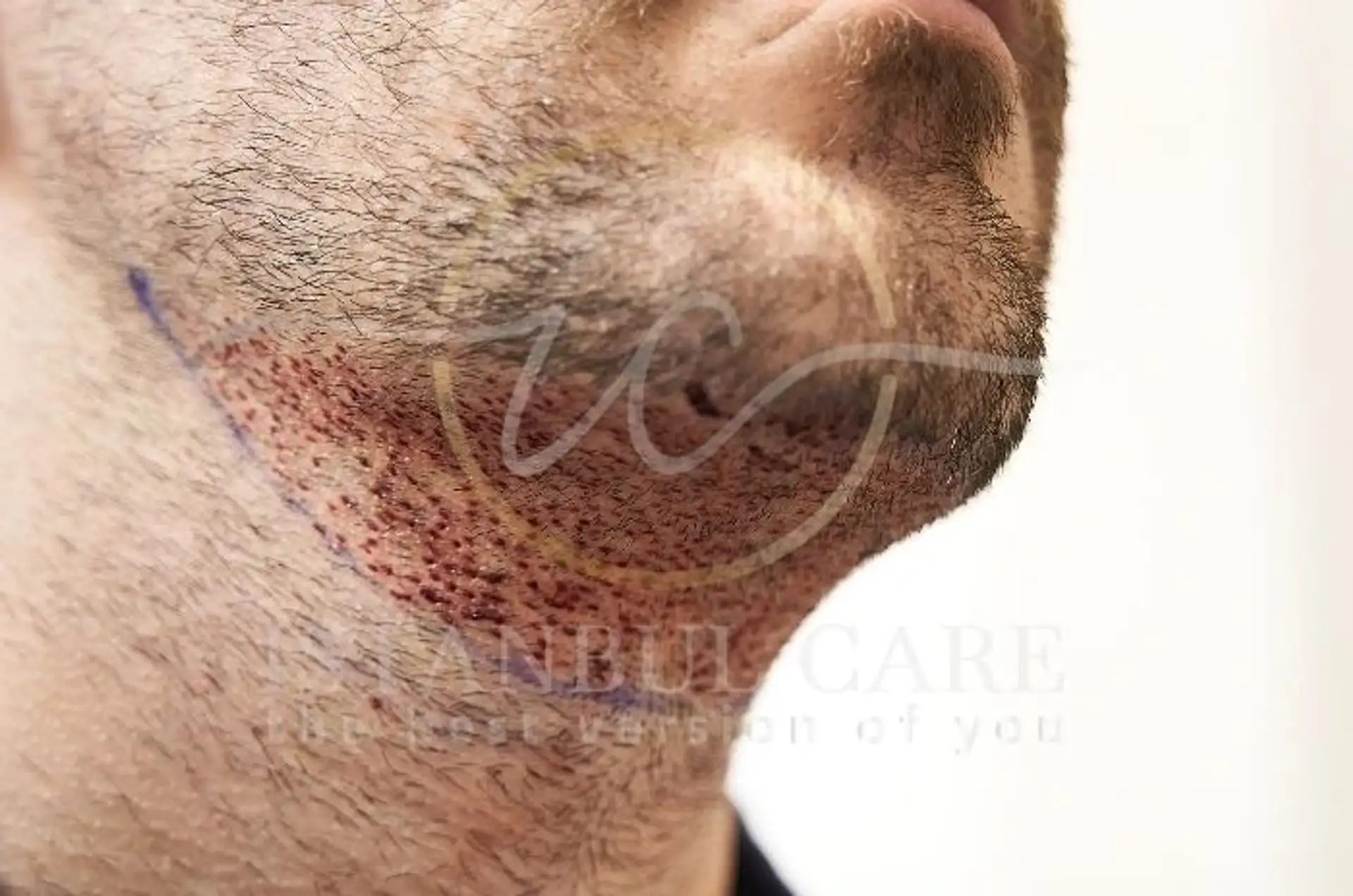 Beard Transplant