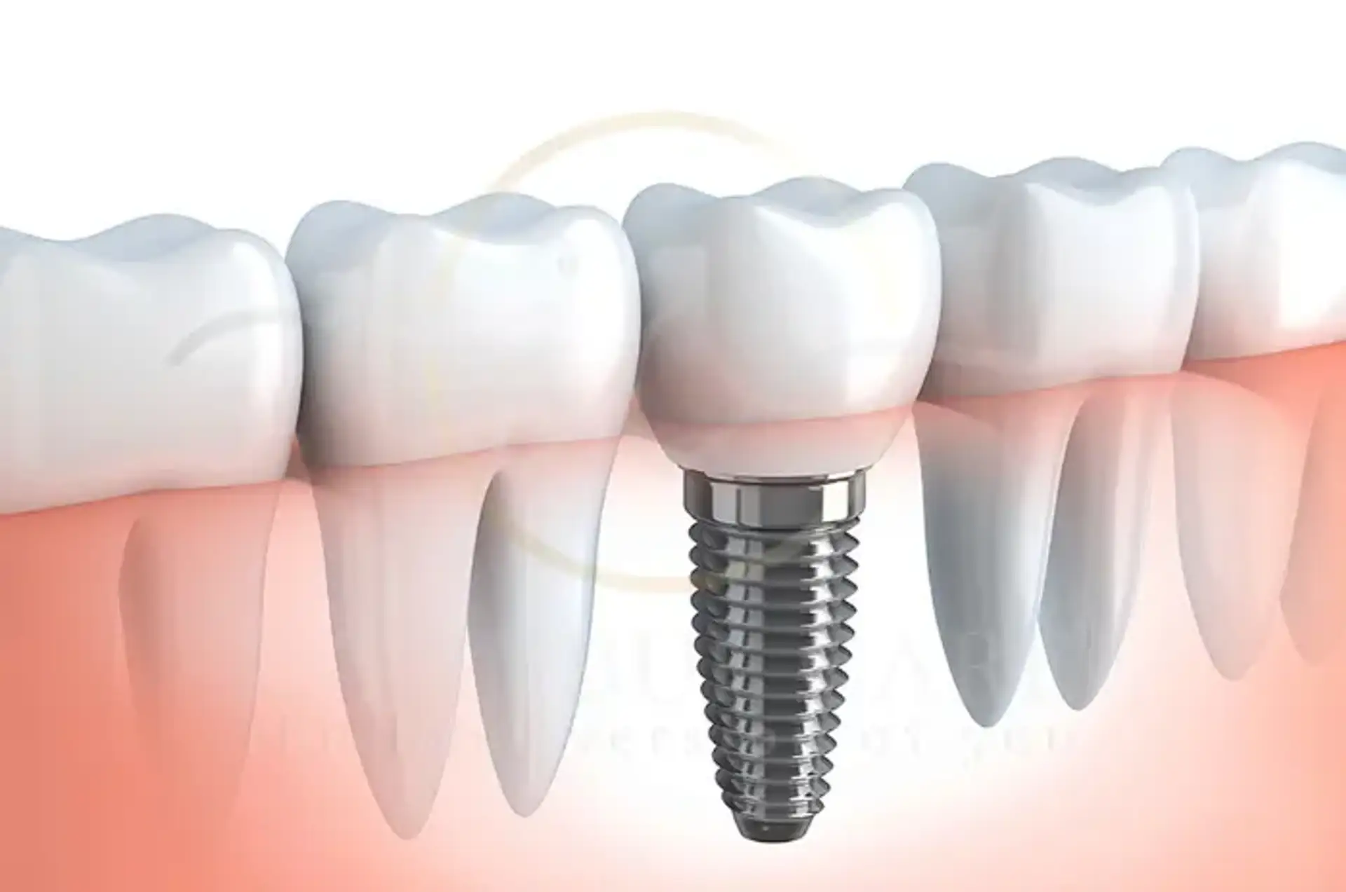 Top 10 Destinations for Dental Implants Abroad