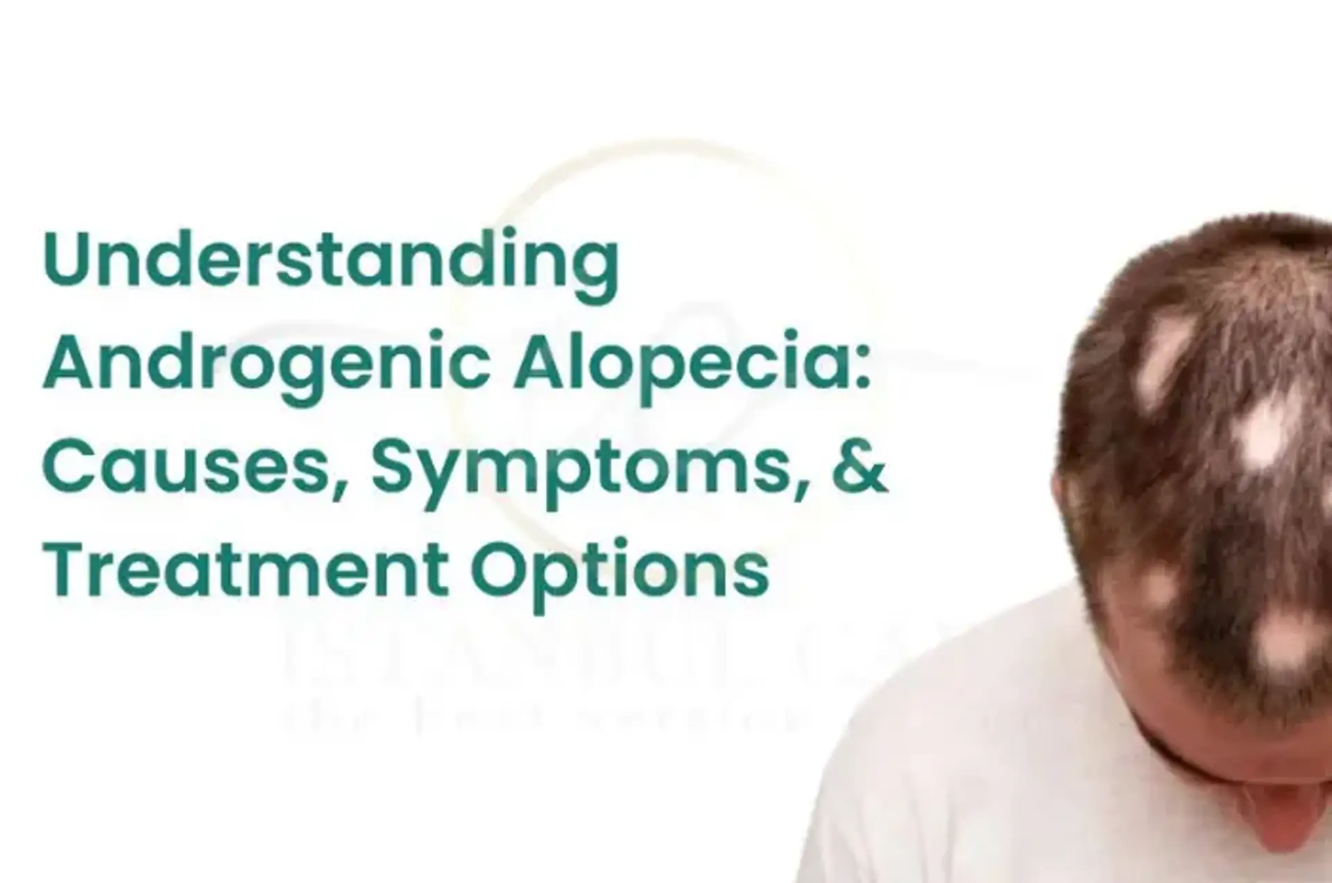 Understanding the Causes of Androgenic Hair Loss