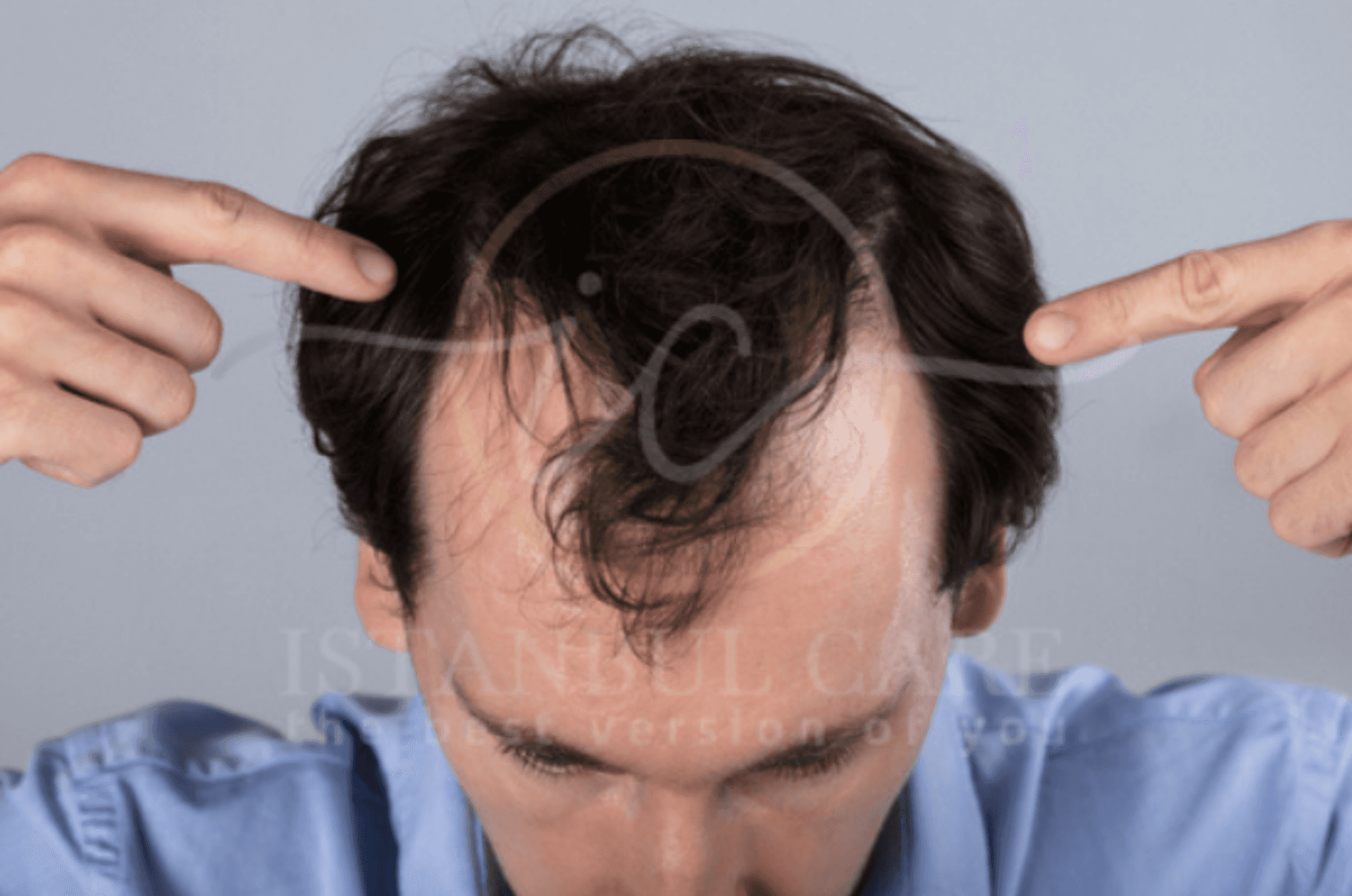 Understanding Stress and Its Impact on Hair Loss