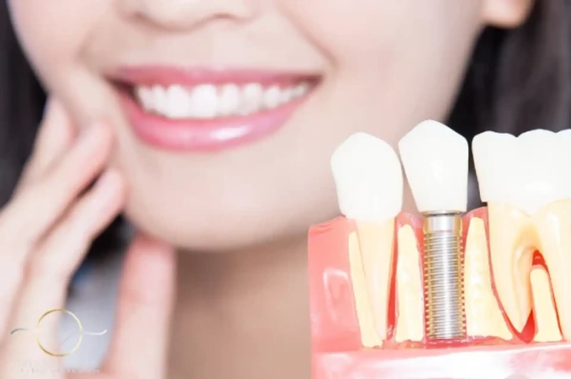 Cheapest Countries for All-on-4 Dental Implants