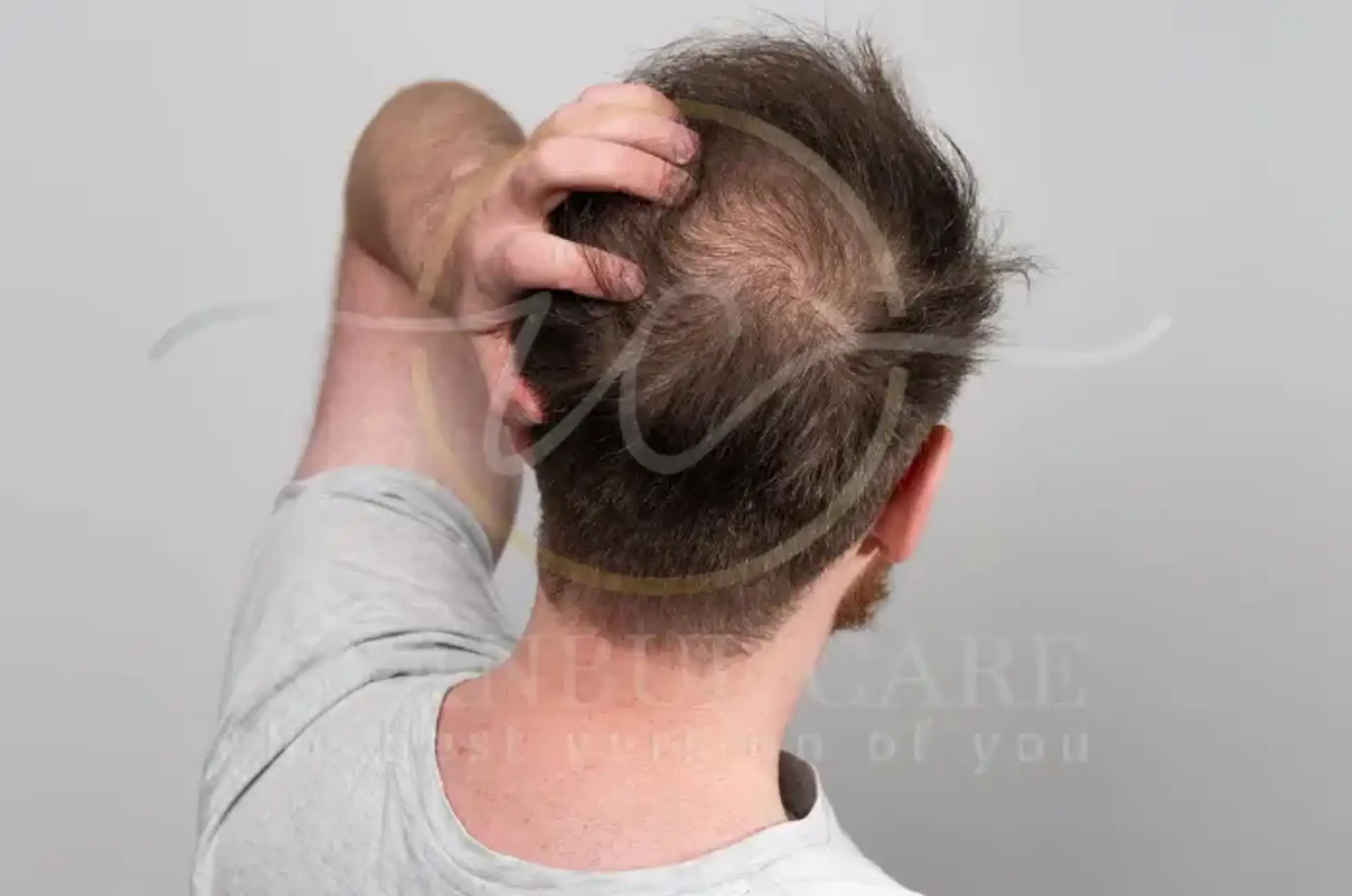 How to Identify and Treat Crown Balding Early