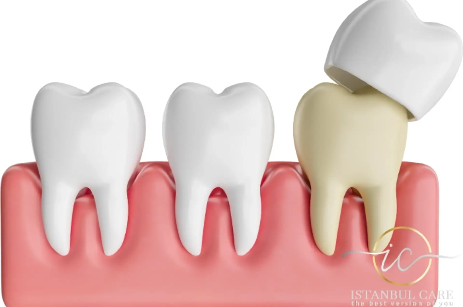Dental Crowns in Albania