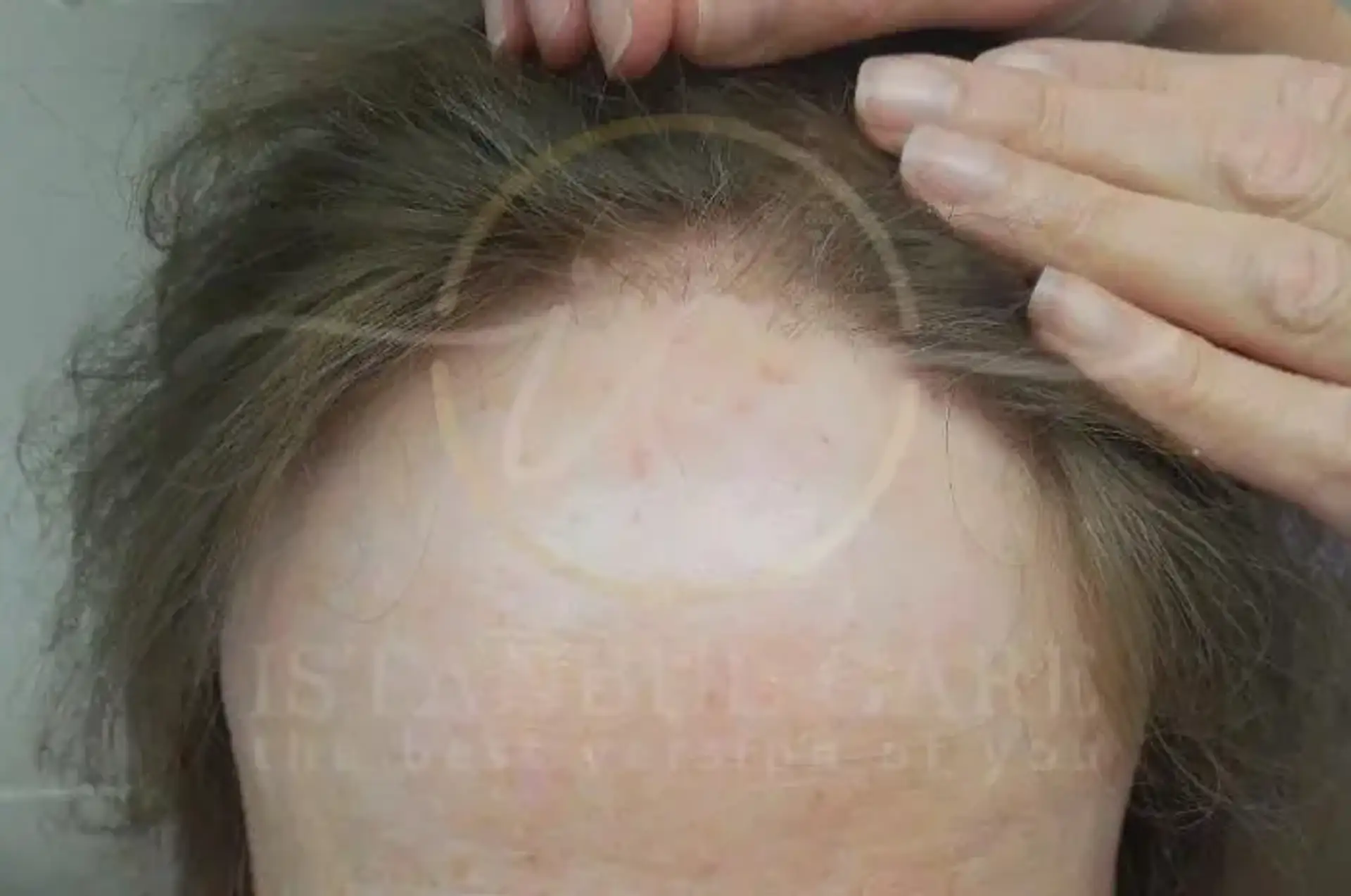 Symptome und Risiken der frontalen fibrosierenden Alopezie