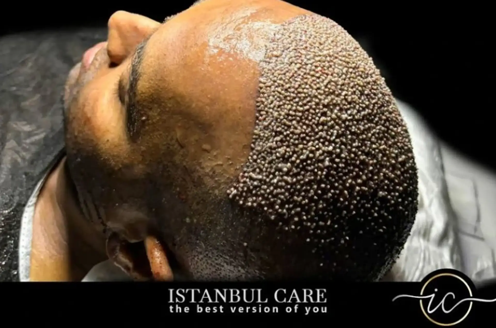 Essential Guide to Hair Restoration Solutions