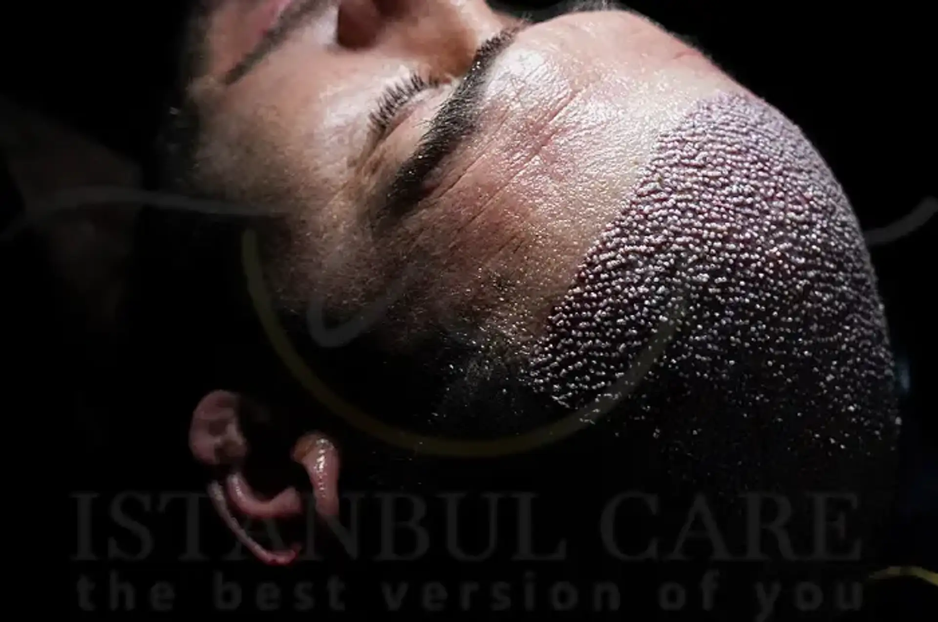Hair Transplant Recovery: Key Care Guidelines