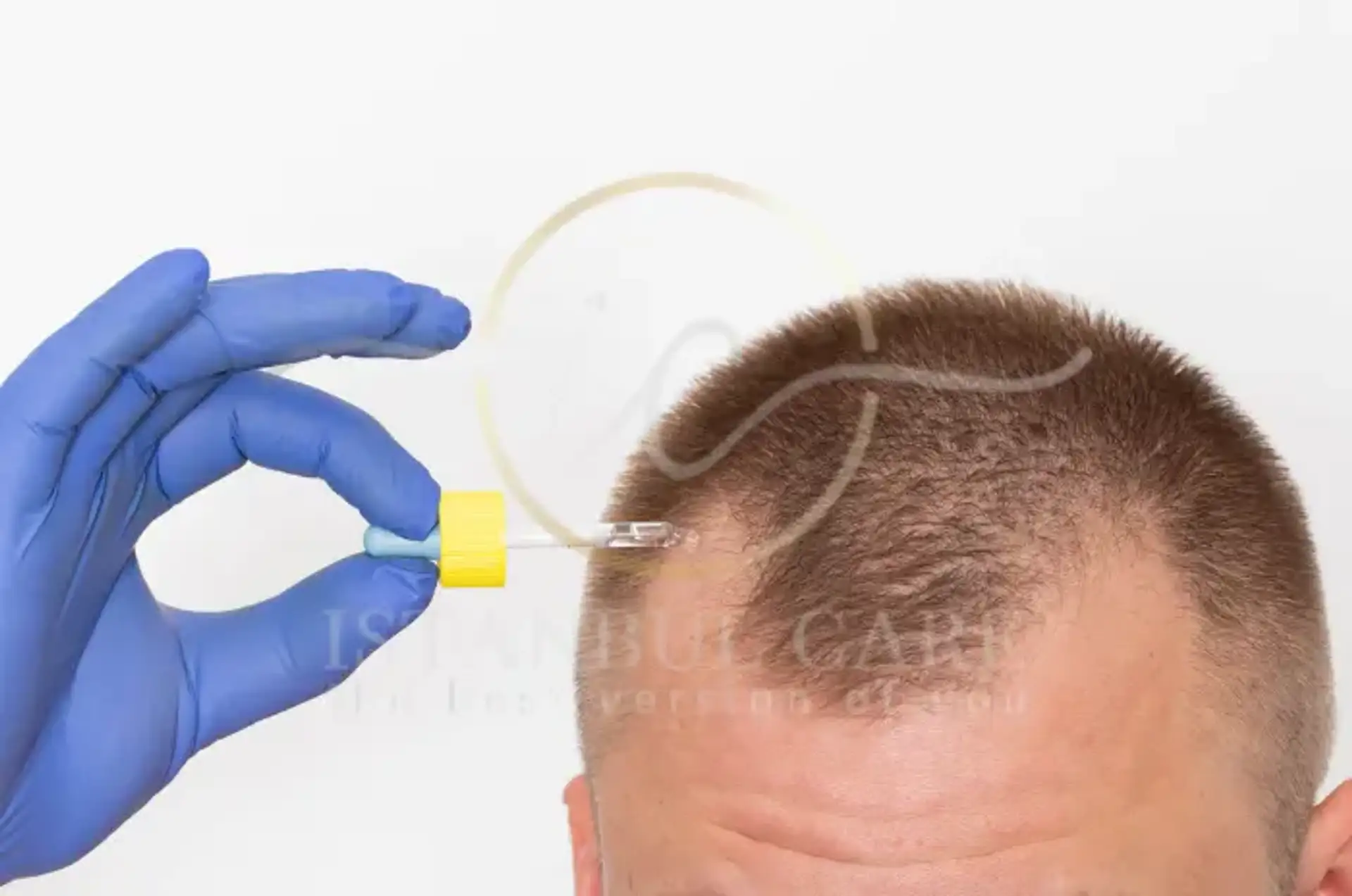 Essential Minoxidil Mistakes You Should Avoid