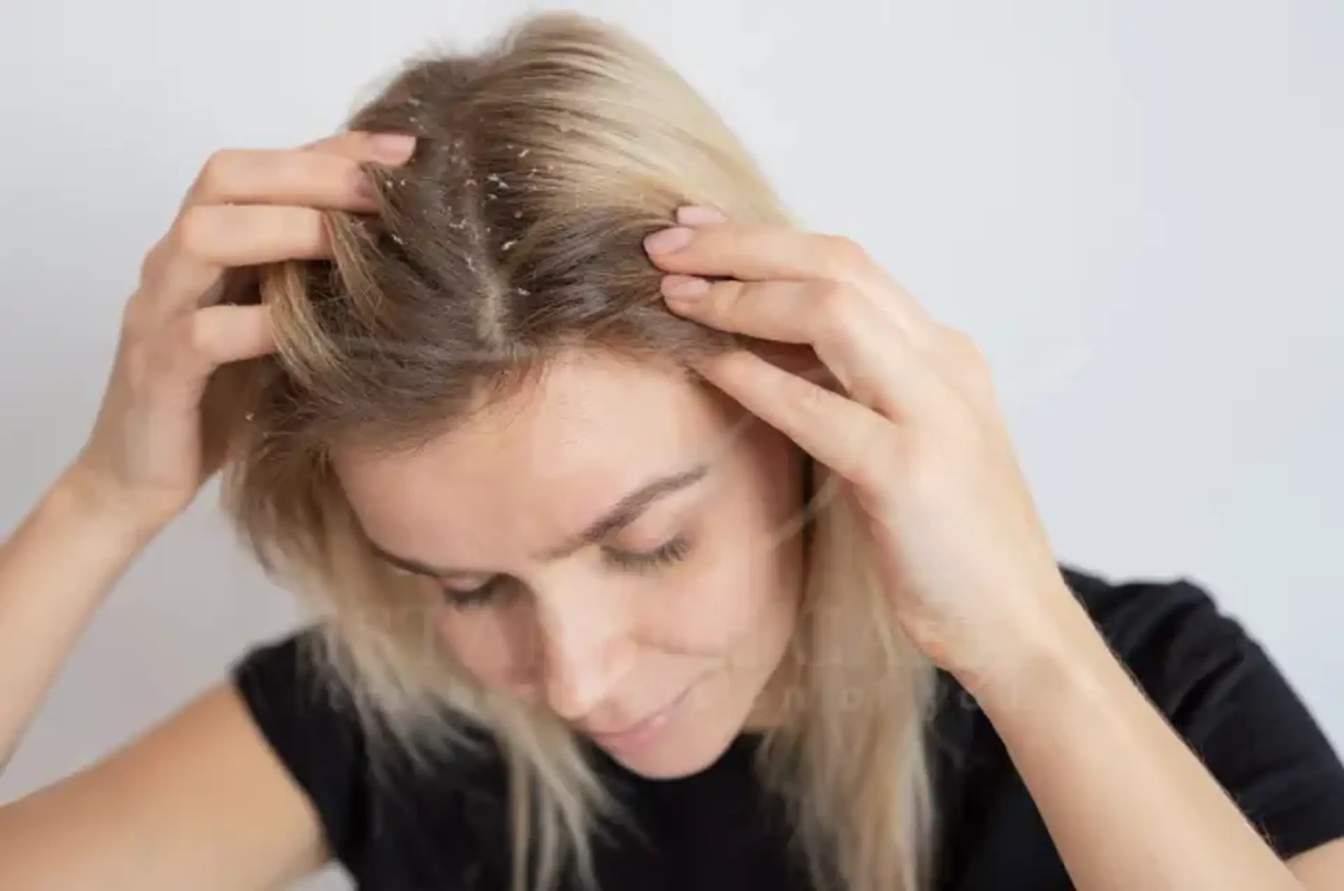 How to Fix Dry Scalp Best Causes Symptoms and Care