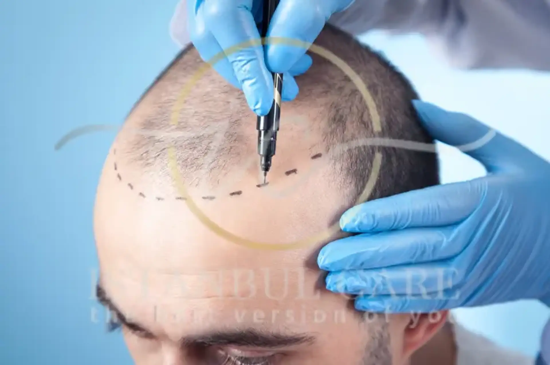 Hairline Transplant Procedure Benefits and Results
