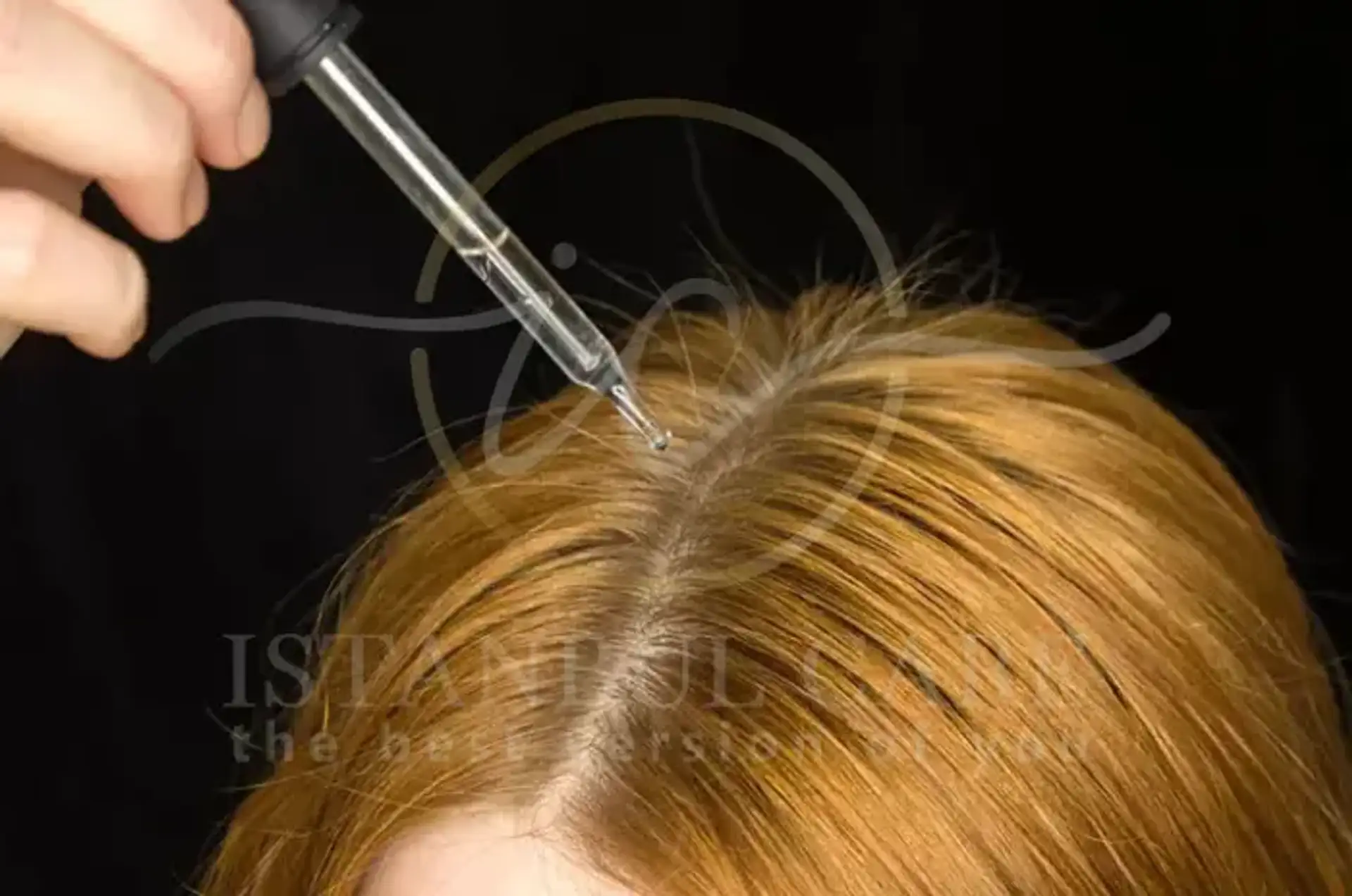 How Levothyroxine Impacts Hair Loss and Solutions