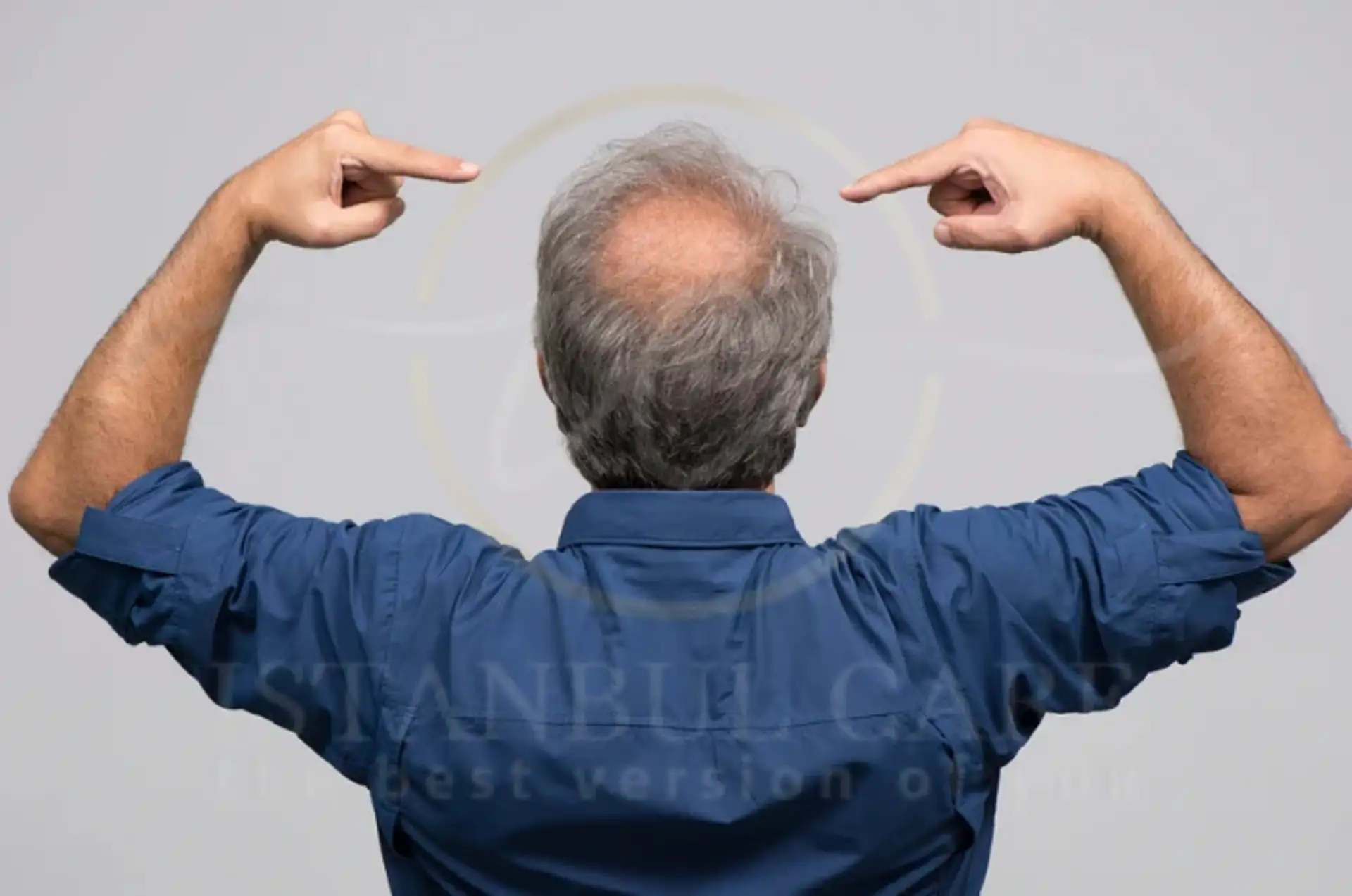 Male Baldness: Top Causes, Treatments & Prevention
