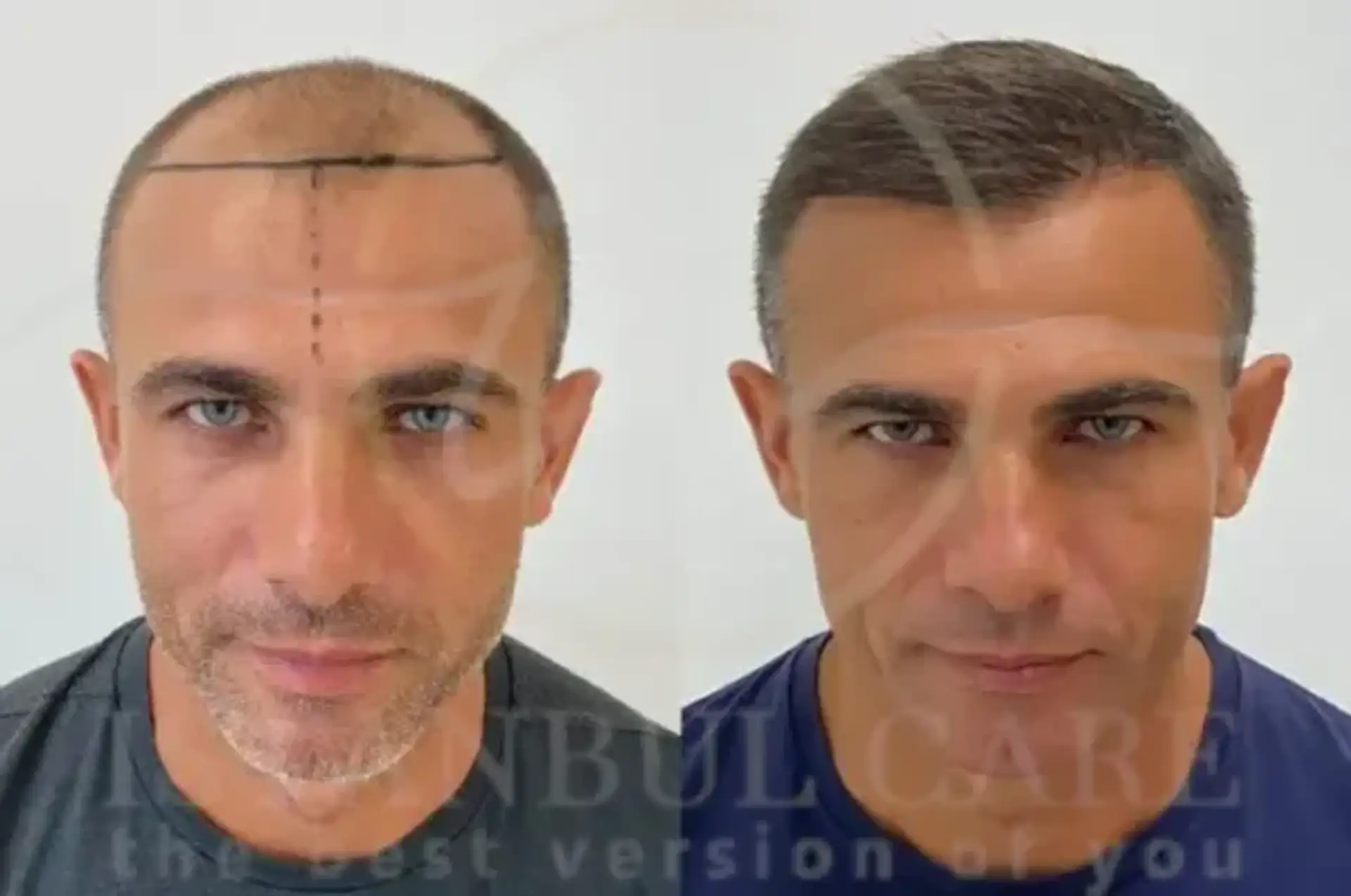 Mature Hairline Vs Receding Hairline: A Detailed Guide