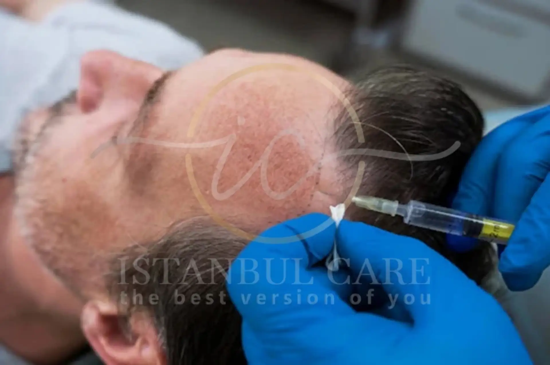 Stem Cell Hair Transplants vs Treatments Explained
