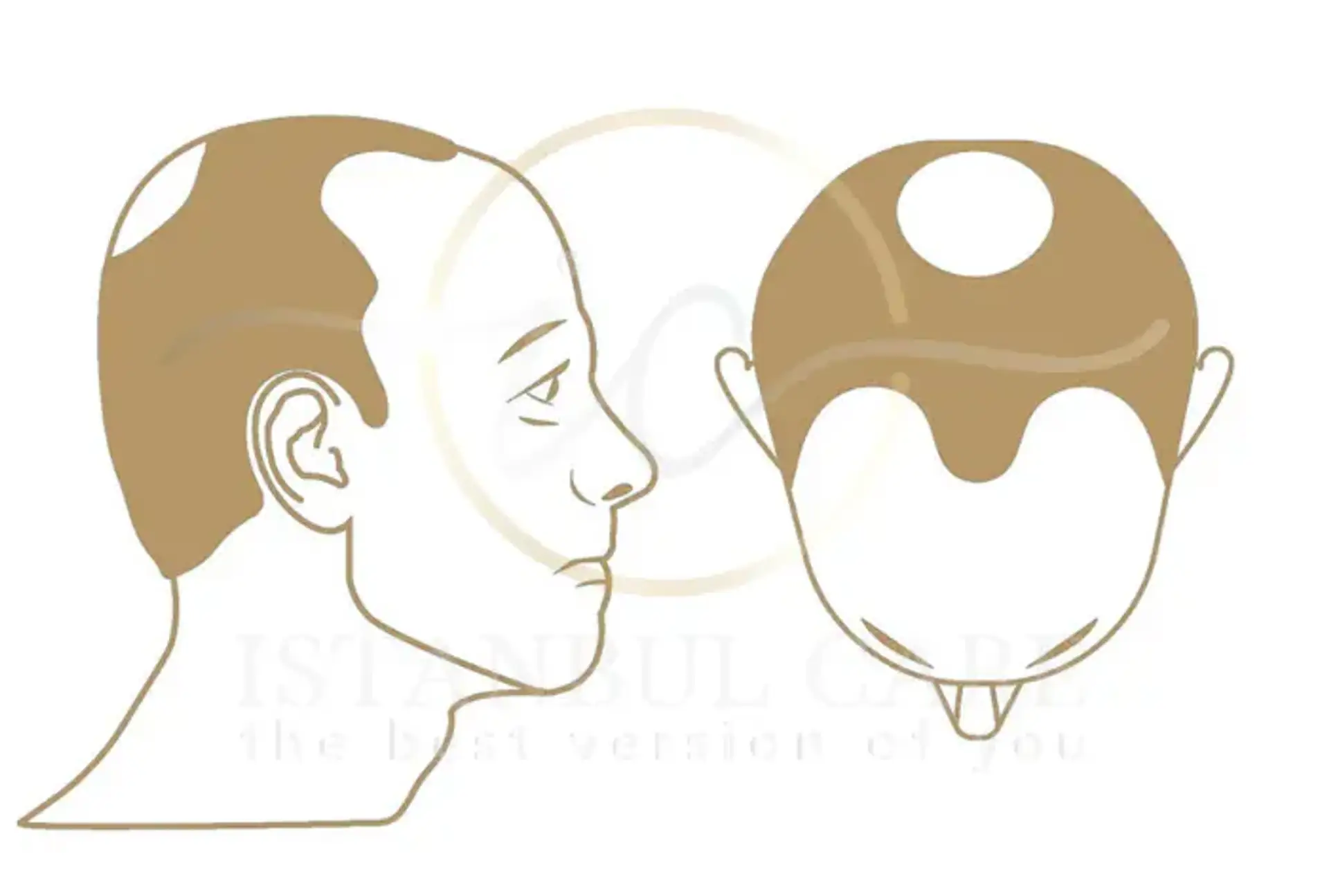 A Comprehensive Guide to the Norwood Scale of Hair Loss