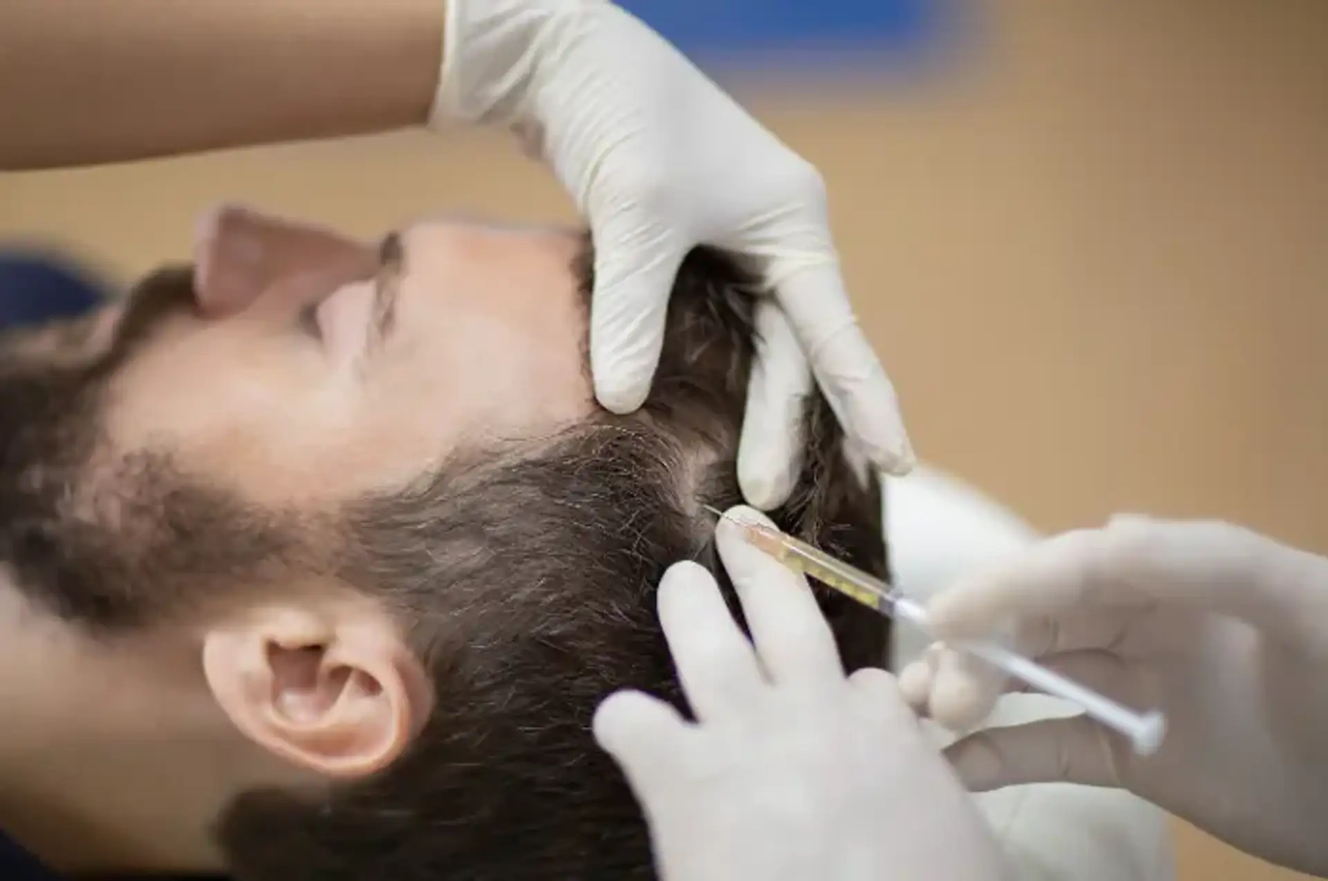 PRP Hair Loss Results How It Works and Ideal Candidates