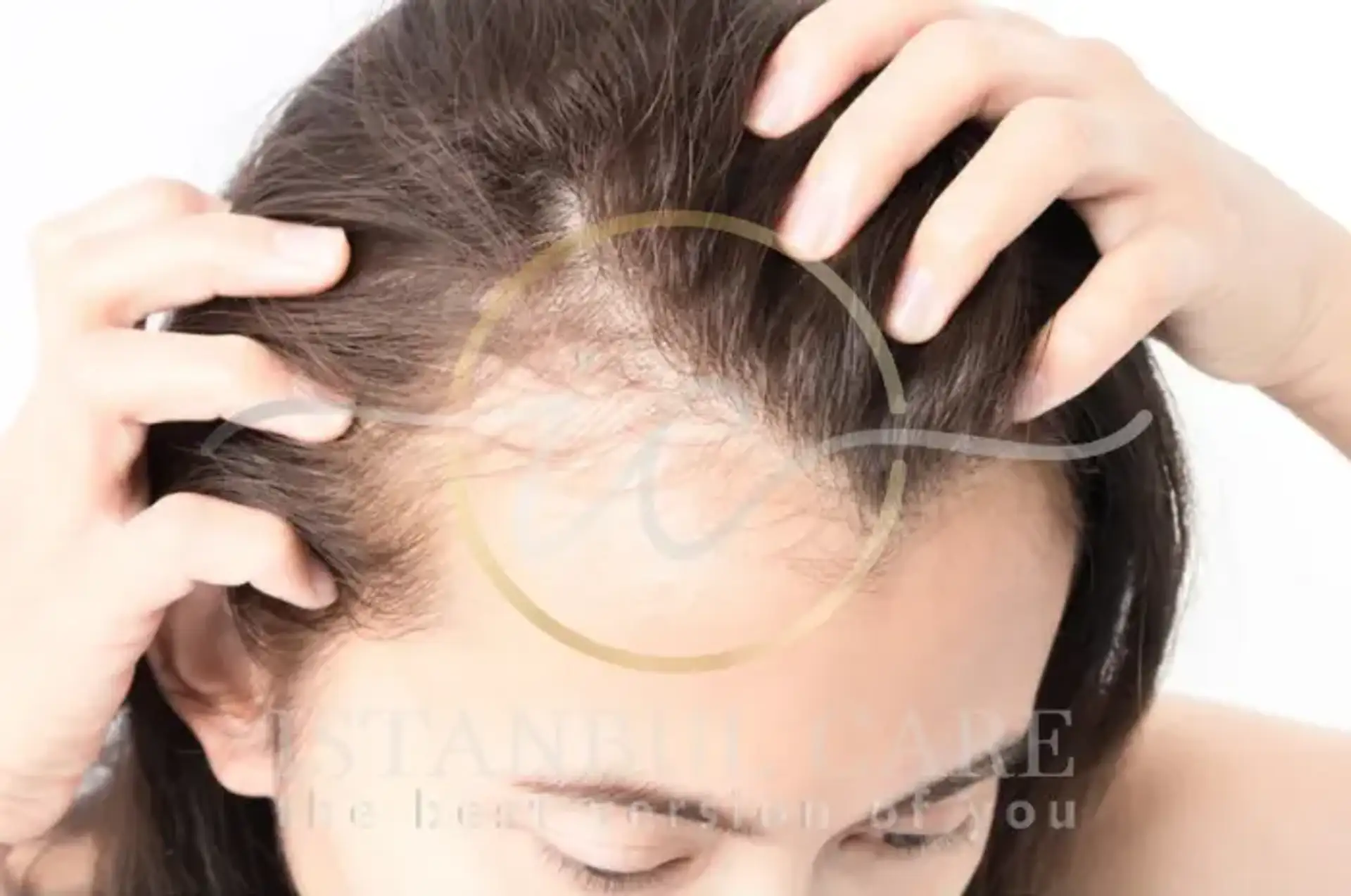 Understanding Postpartum Hair Loss and Treatments