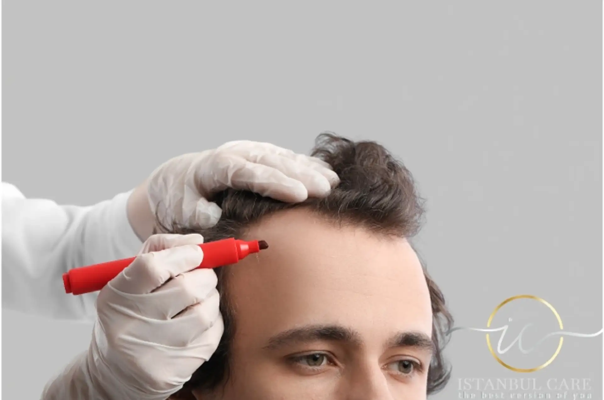 Top Hair Transplant Techniques in Istanbul Explained