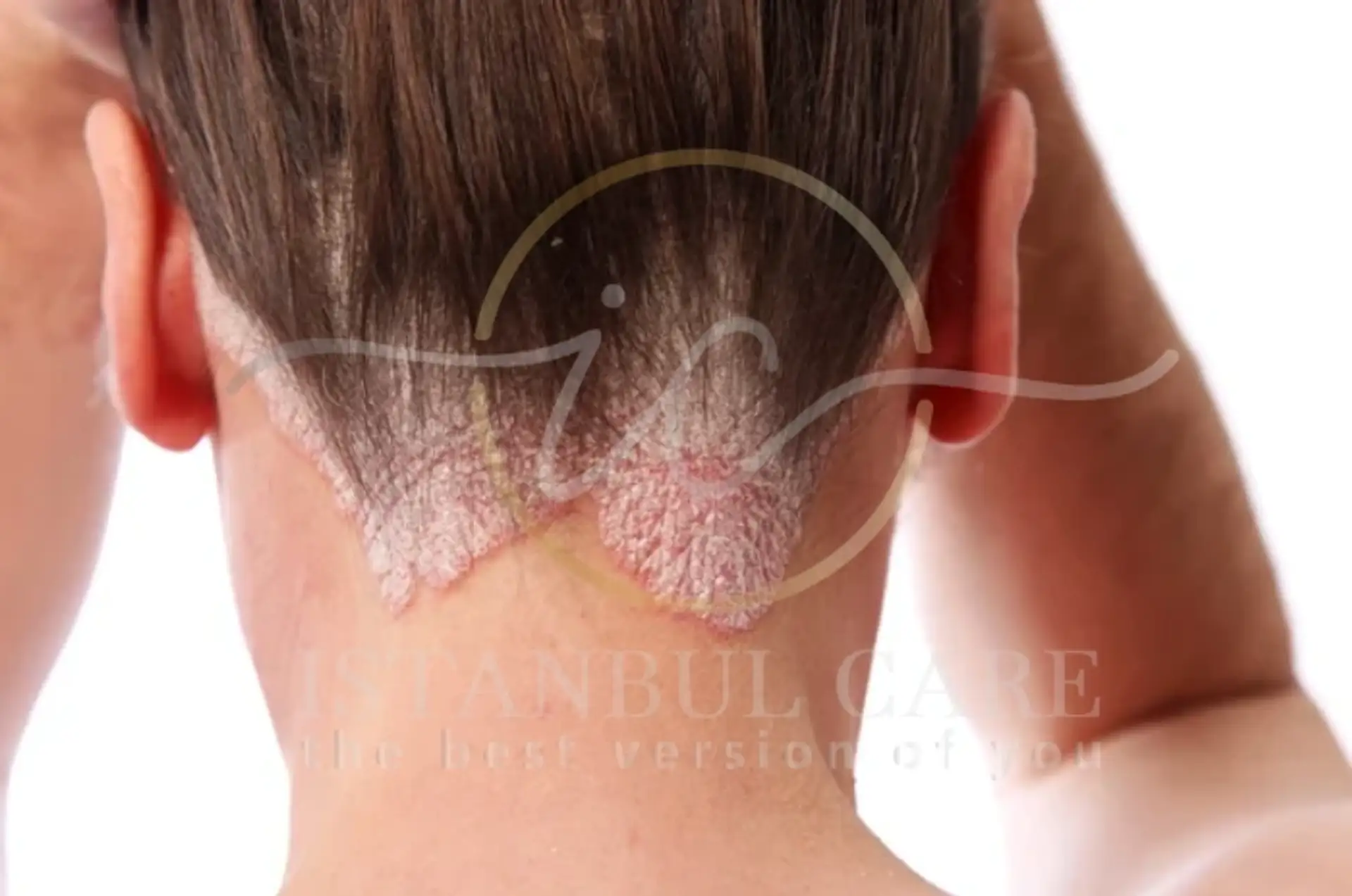 Understanding Scalp Acne: Causes and Solutions
