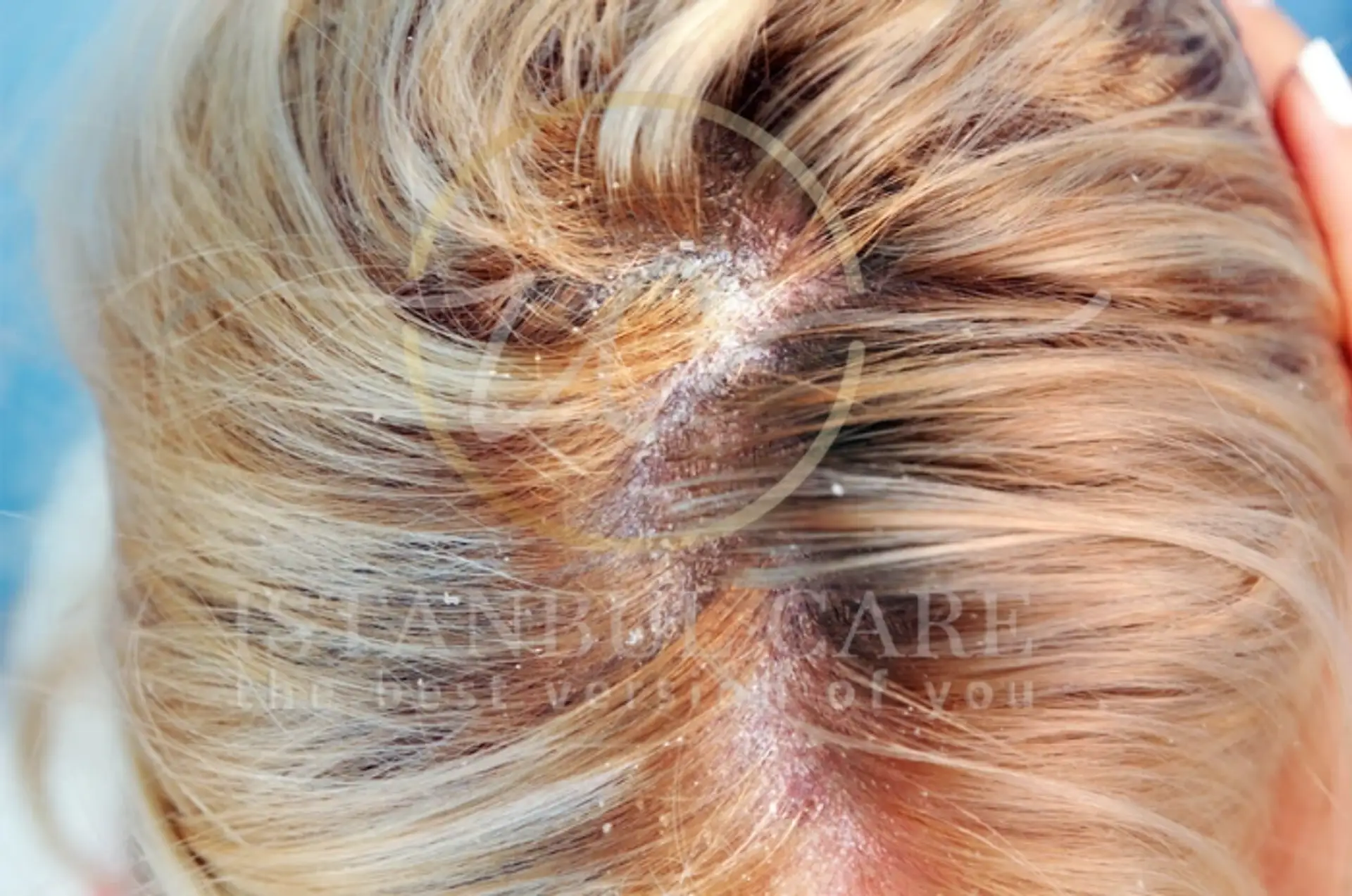 Understanding Scalp Yeast Infections and Treatments