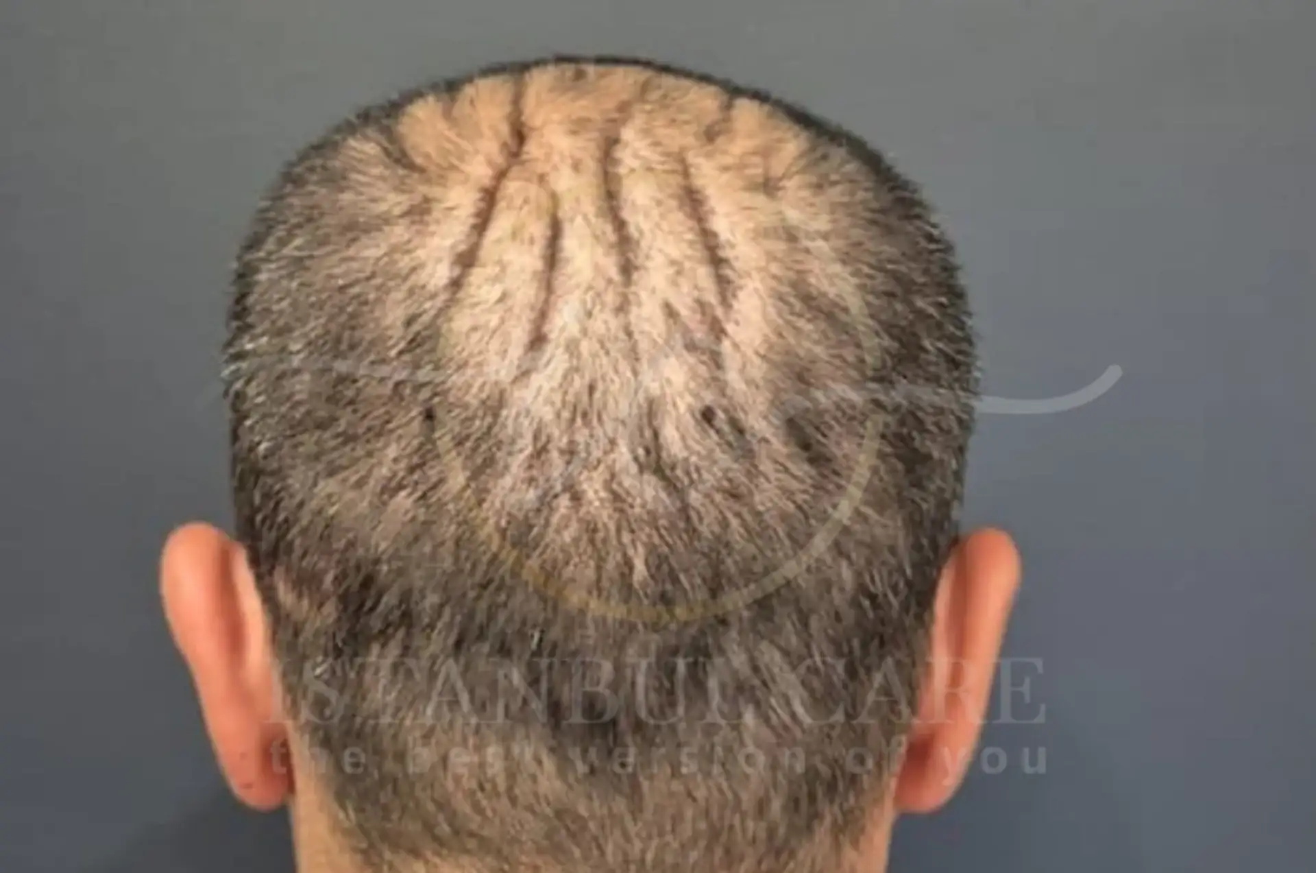 Understanding Scalp Reduction Surgery for Hair Loss