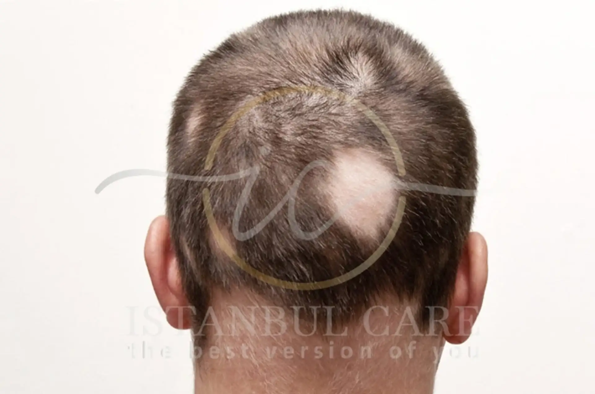 Understanding Scarring Alopecia: Causes & Treatments