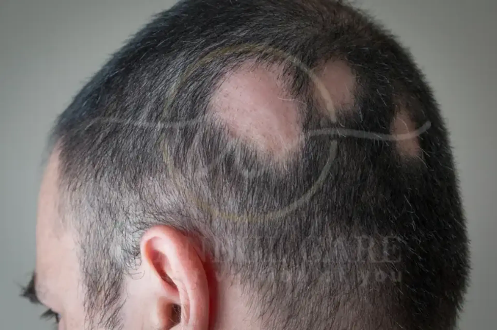 Ringworm In Hair Signs Causes and Safe Care Treatments