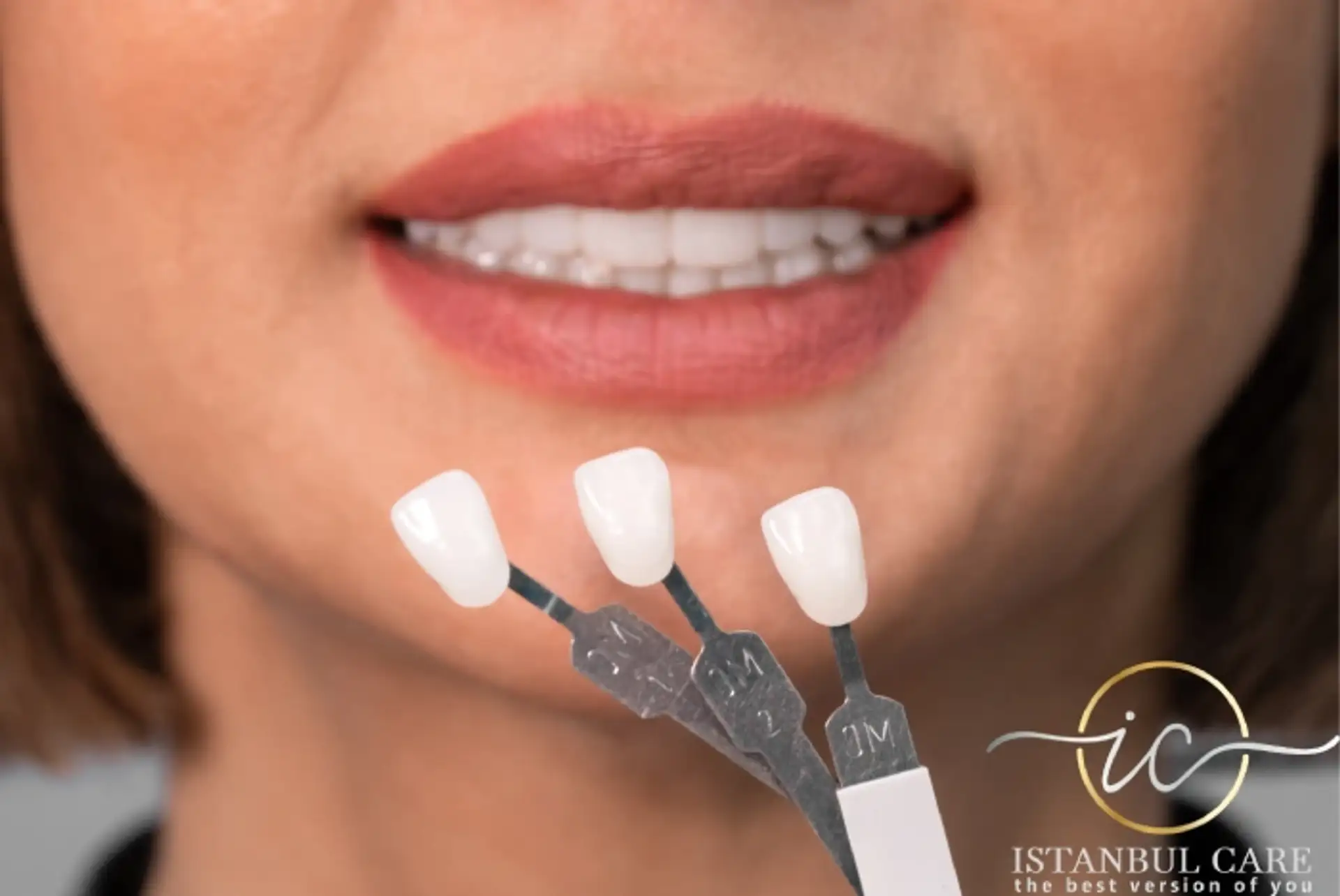 Porcelain Veneers in Albania: Affordable Quality
