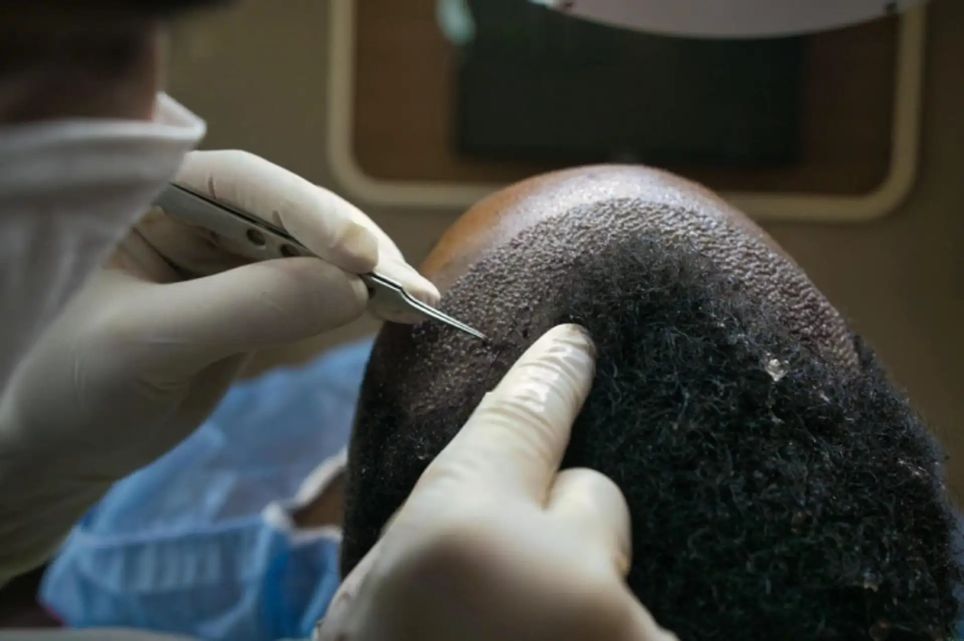 Are Hair Transplants Detectable? A Closer Look