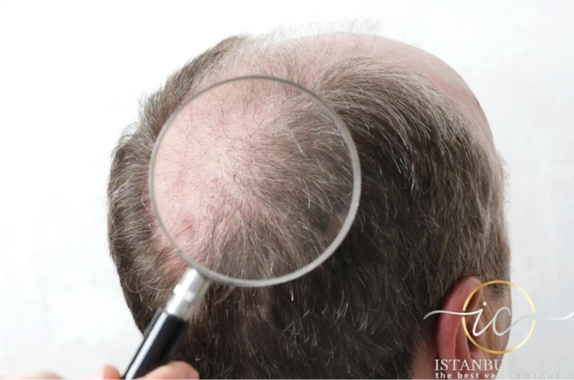 Understanding Hair Transplant Recovery Stages