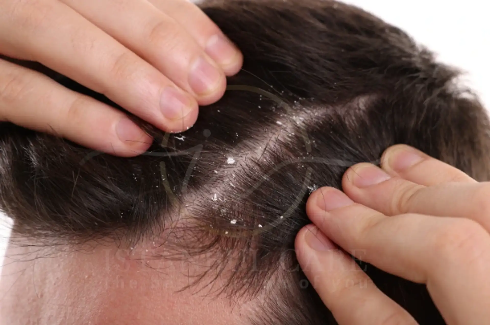 Can Dandruff Cause Hair Loss and How to Stop It