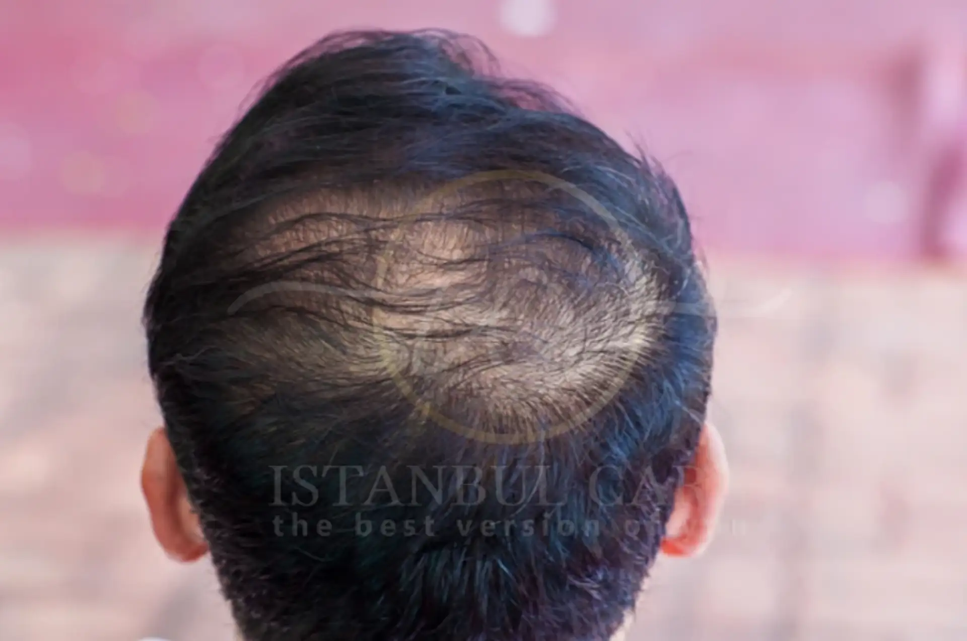Understanding Telogen Effluvium: Causes and Care