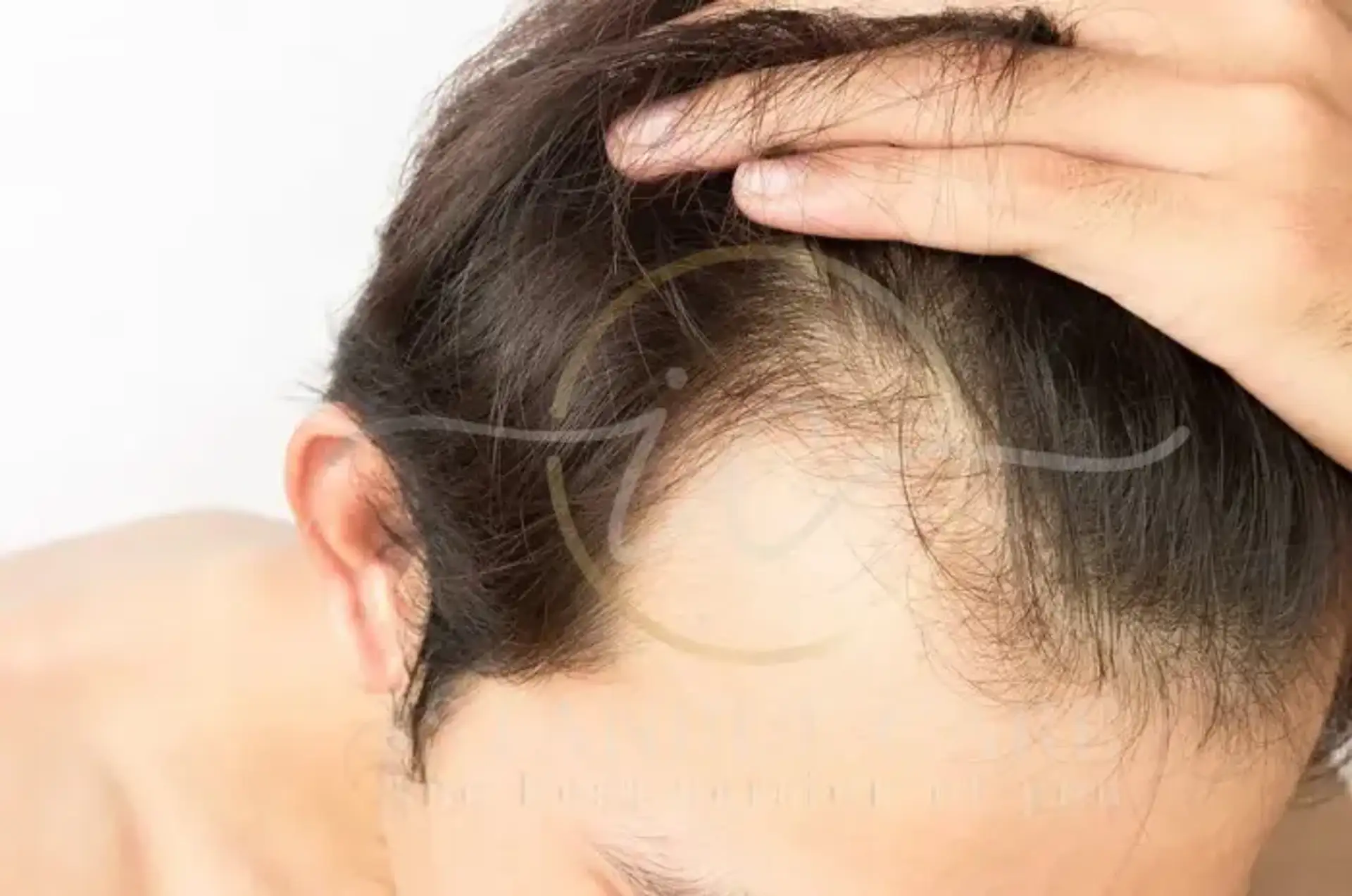Testosterone and Hair Loss The Real Link to Baldness