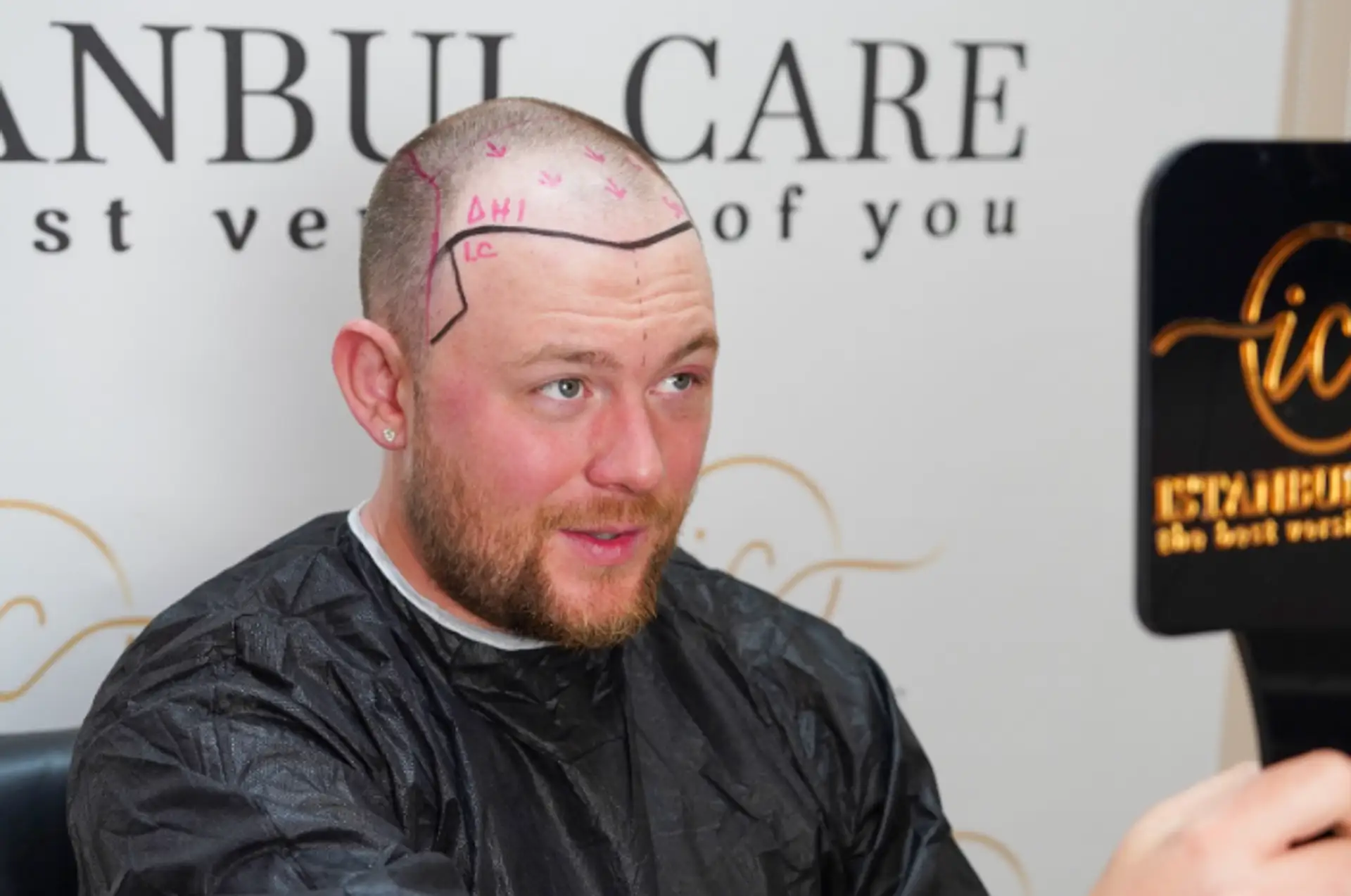hair grafting