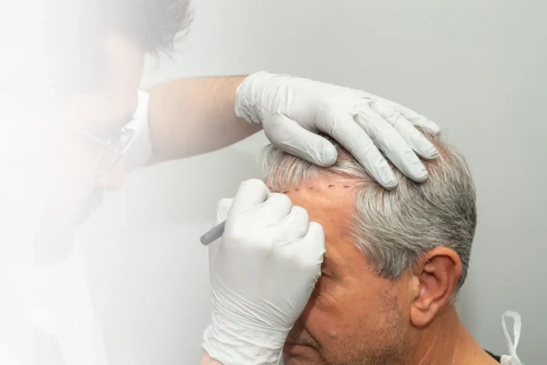 Preparação para o transplante capilar: Dicas para as semanas antes da cirurgia