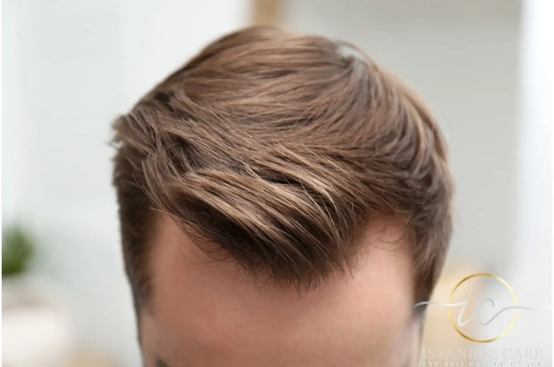 Hair Transplant Before and After