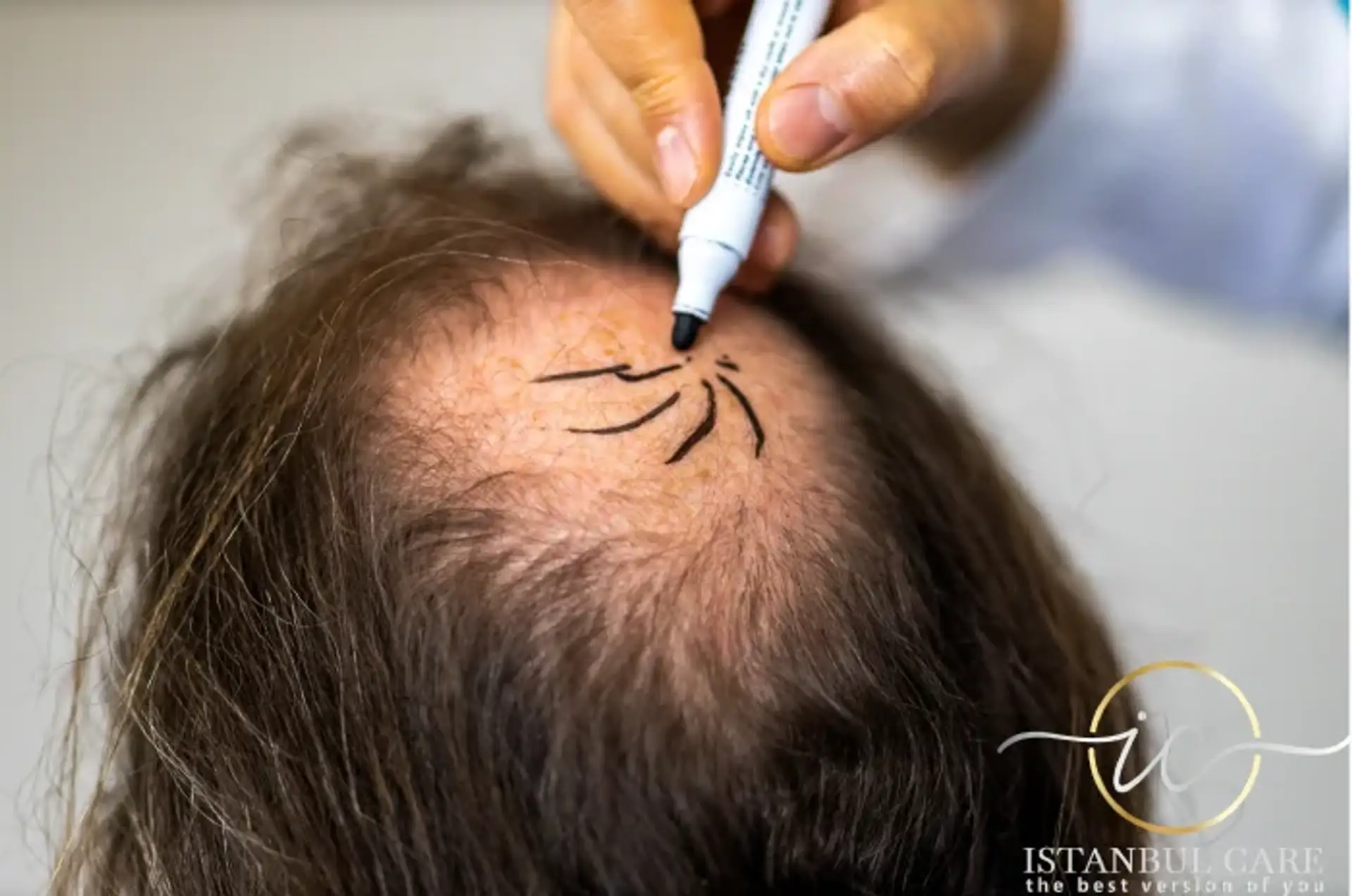Are You a Good Candidate for Hair Transplant?