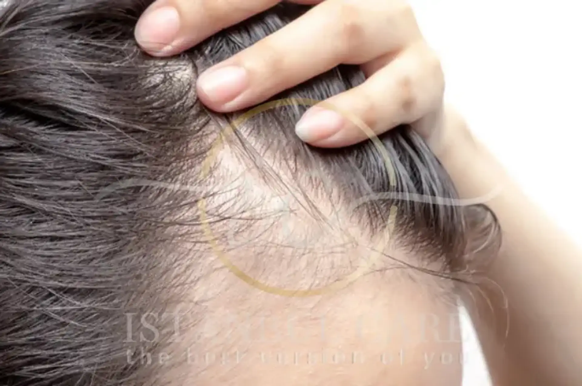 Hair loss