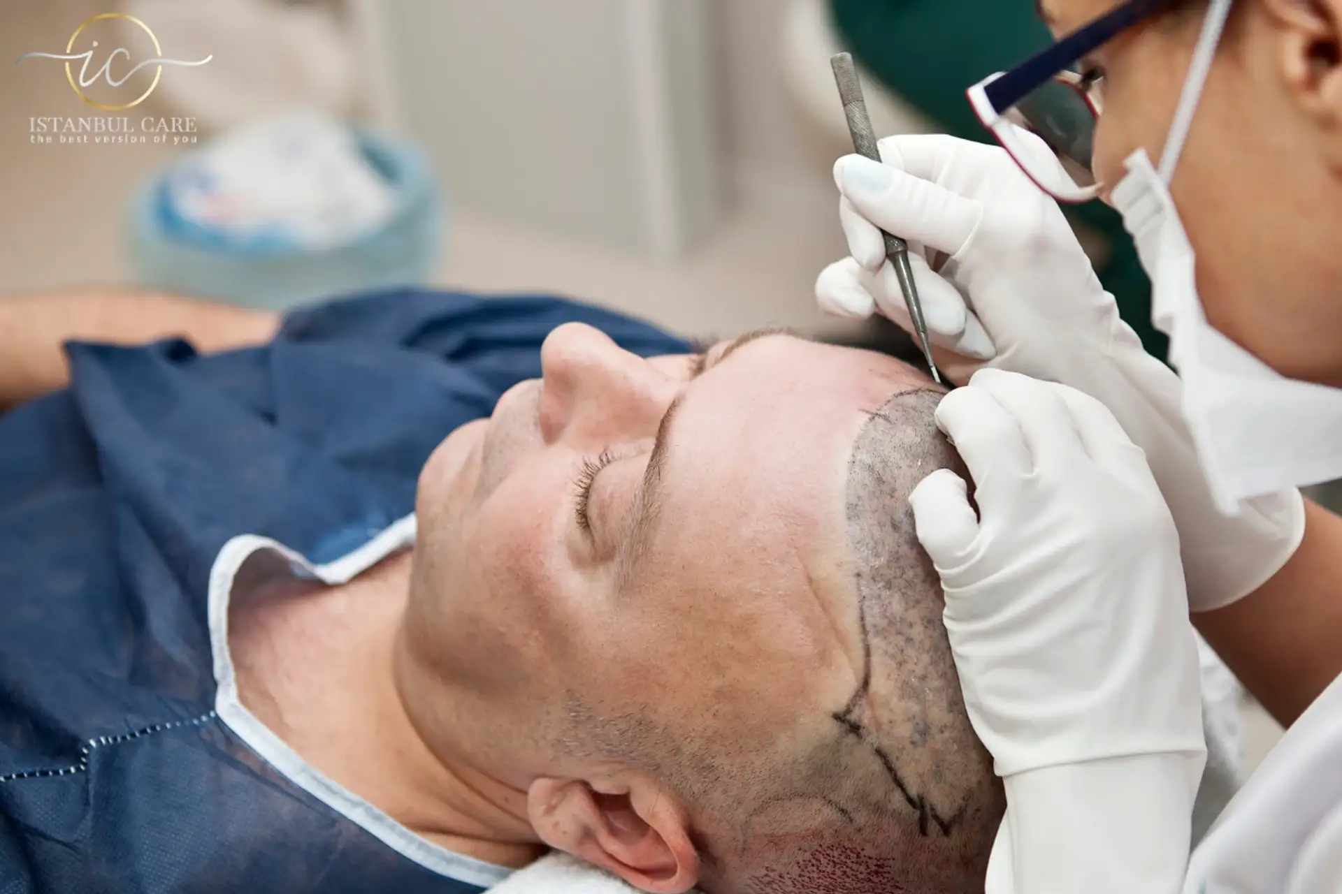 Hair Transplant Maintenance for Lasting Results
