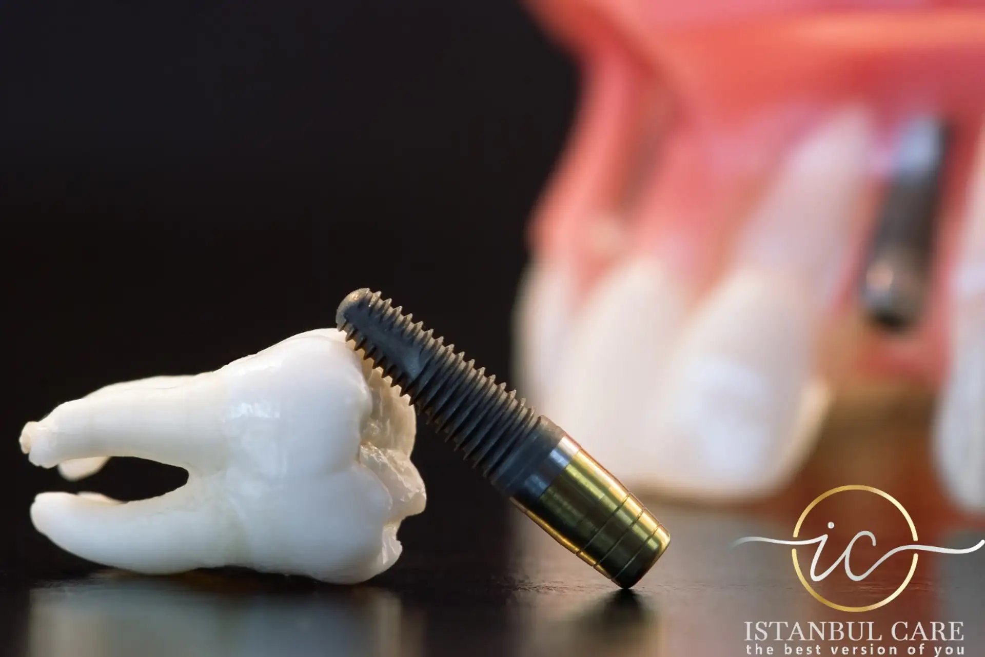 Tratamento de implantes na Turquia - O processo e os benefícios