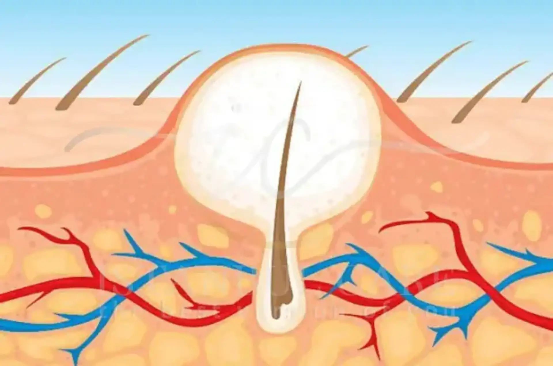 Understanding Ingrown Hair: Causes and Solutions