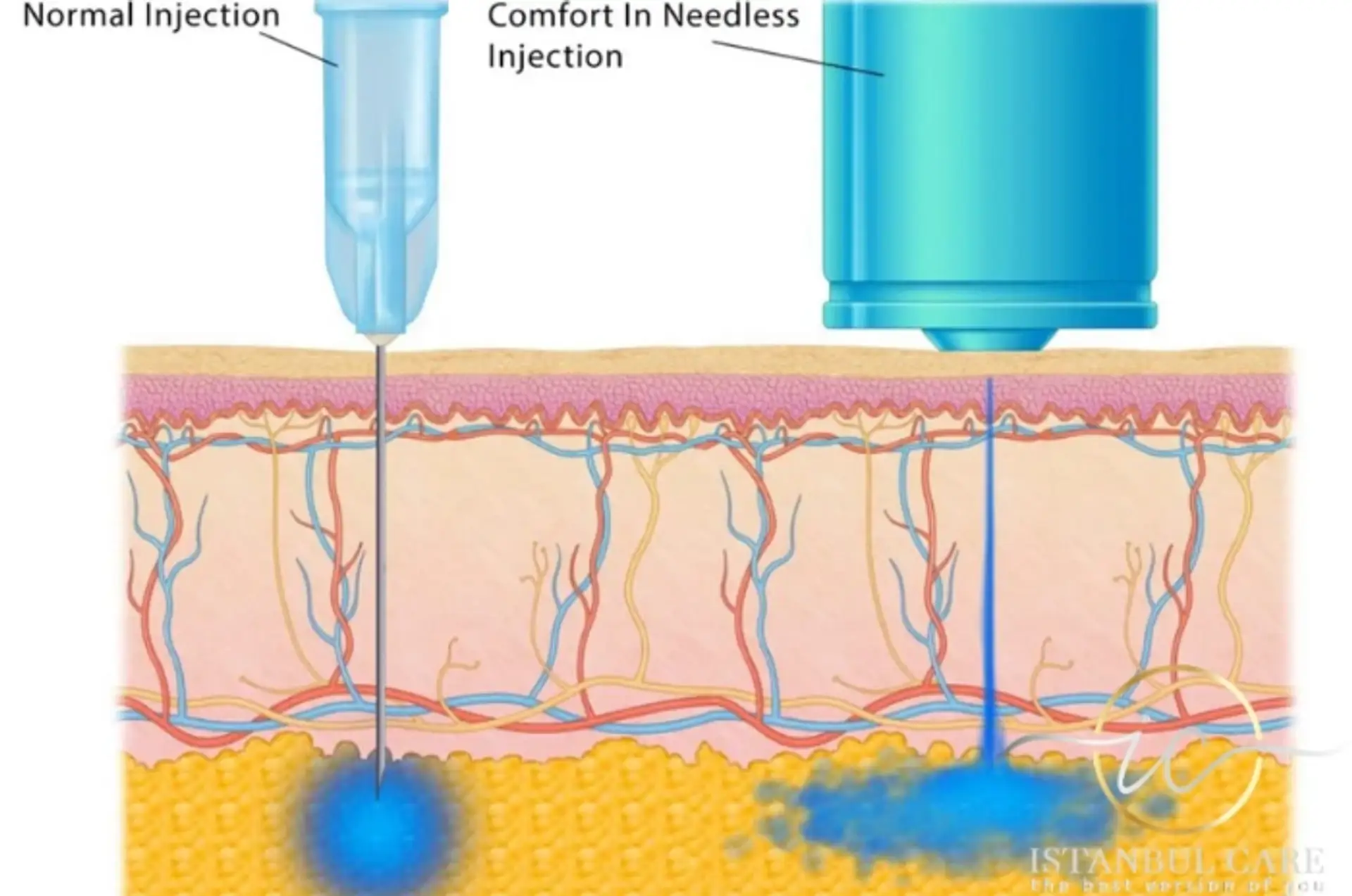 needle free anesthesia hair transplant