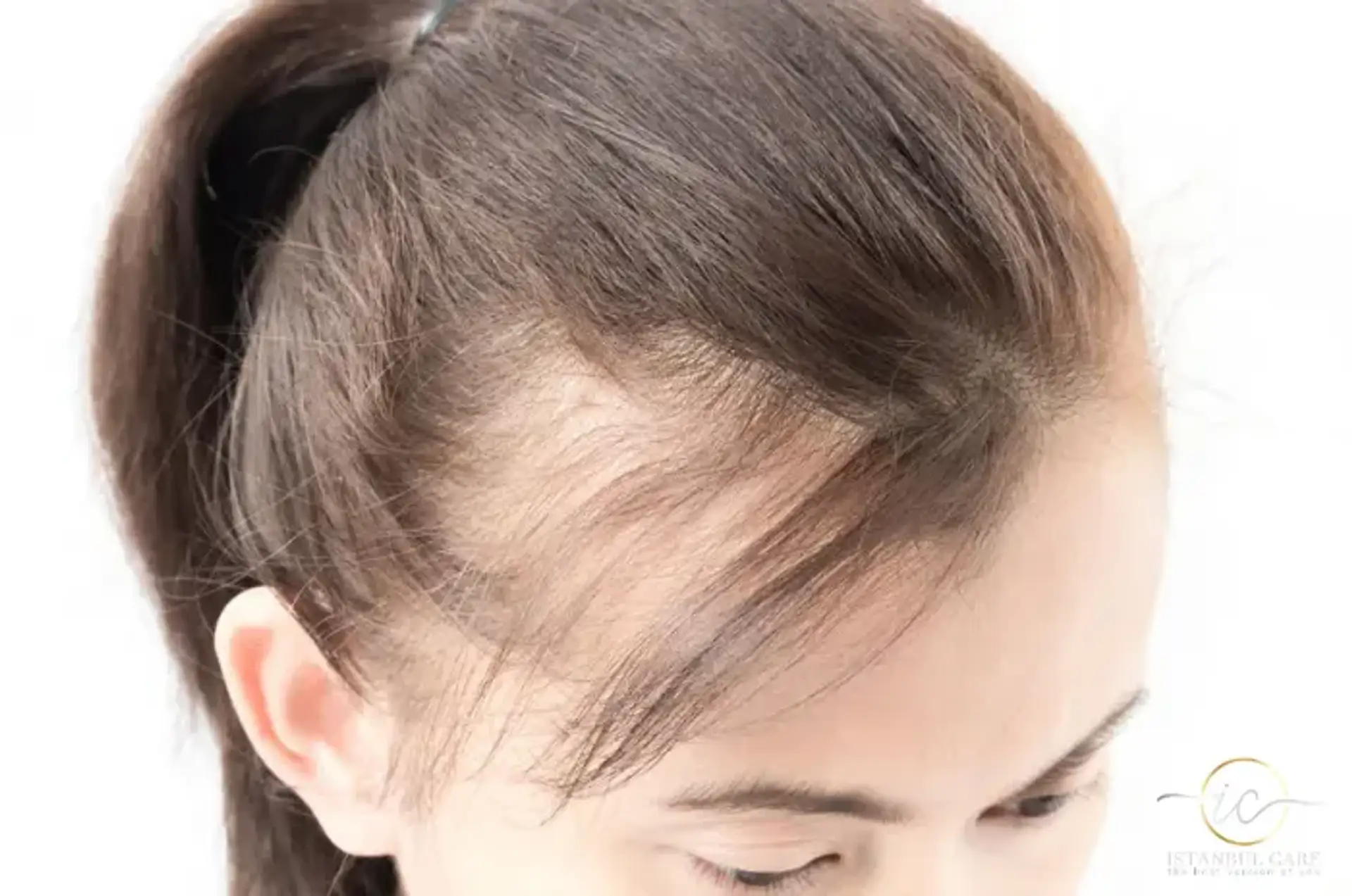 Understanding PCOS Hair Loss and Treatment Options
