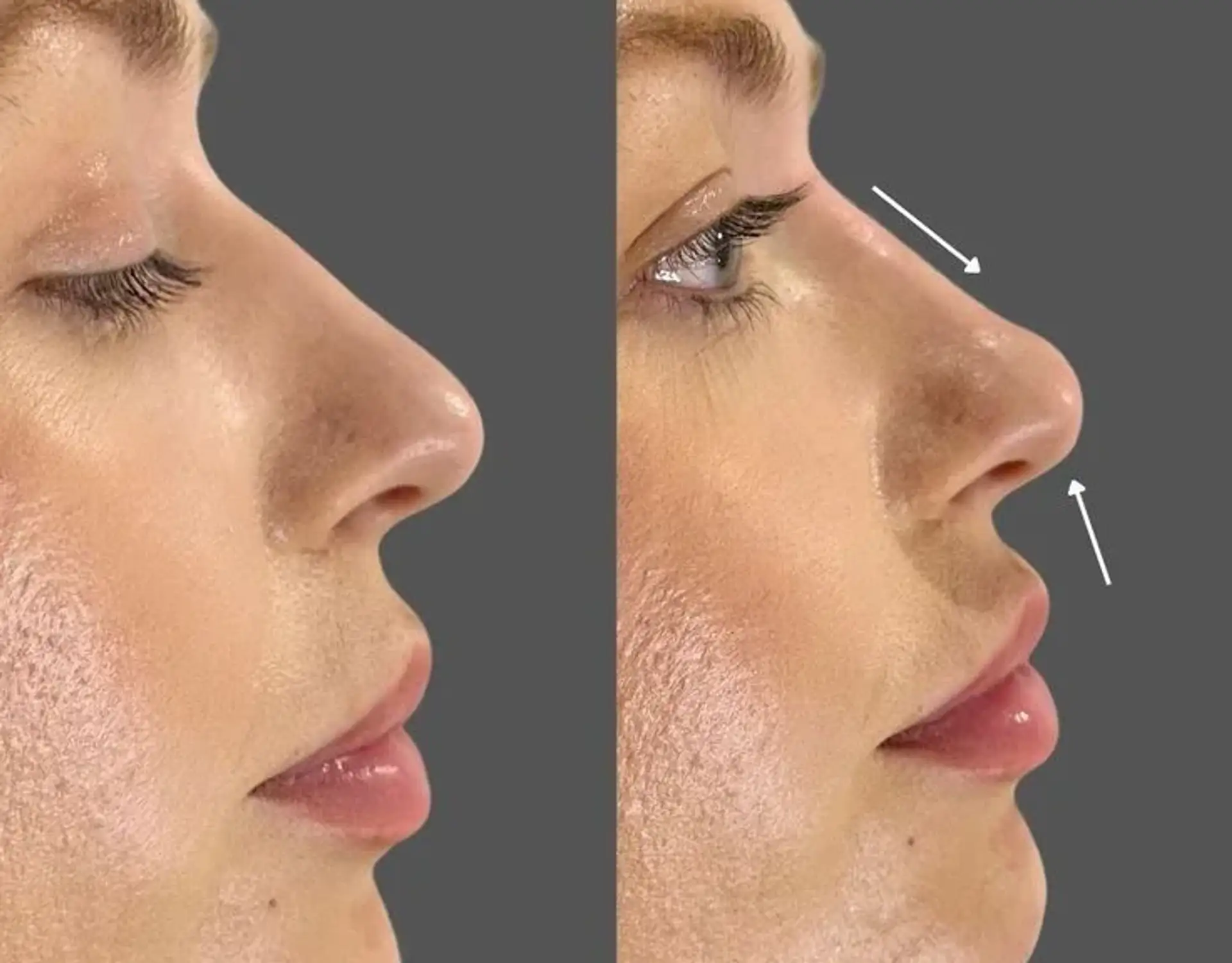 rhinoplasty turkey istanbul-care