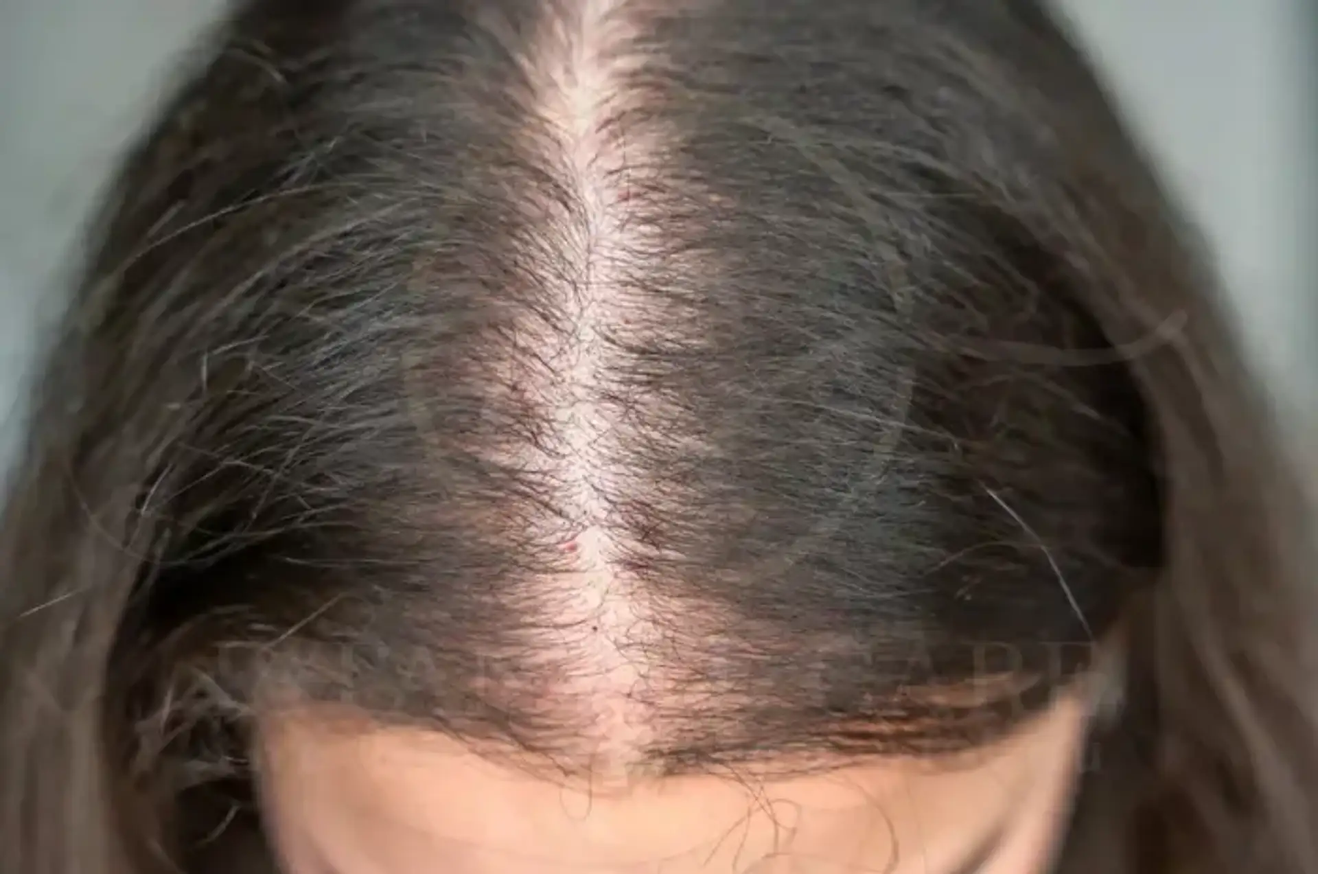 Key Differences: Traction Alopecia and Baldness