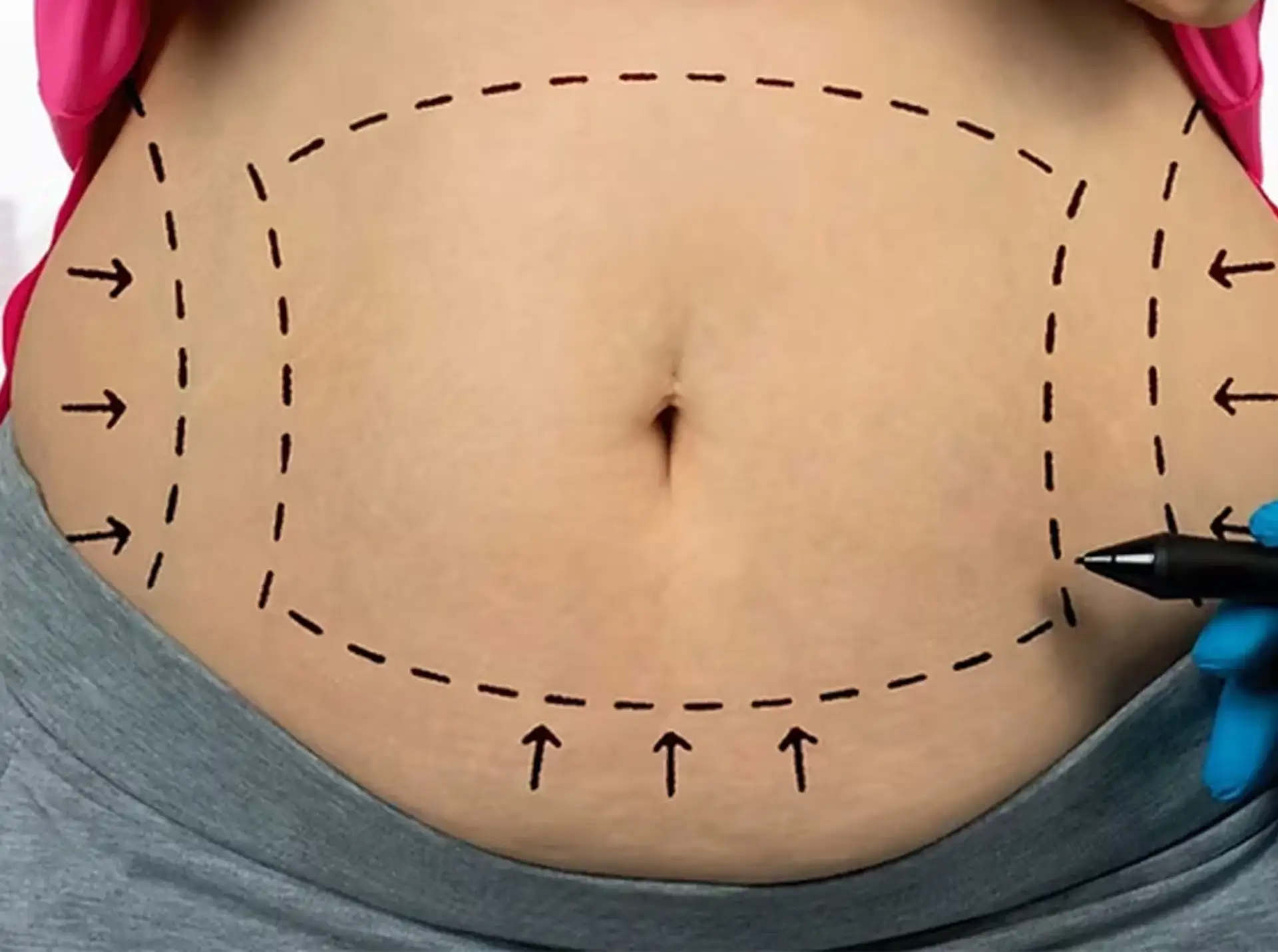 Segni sul ventre per la liposuzione