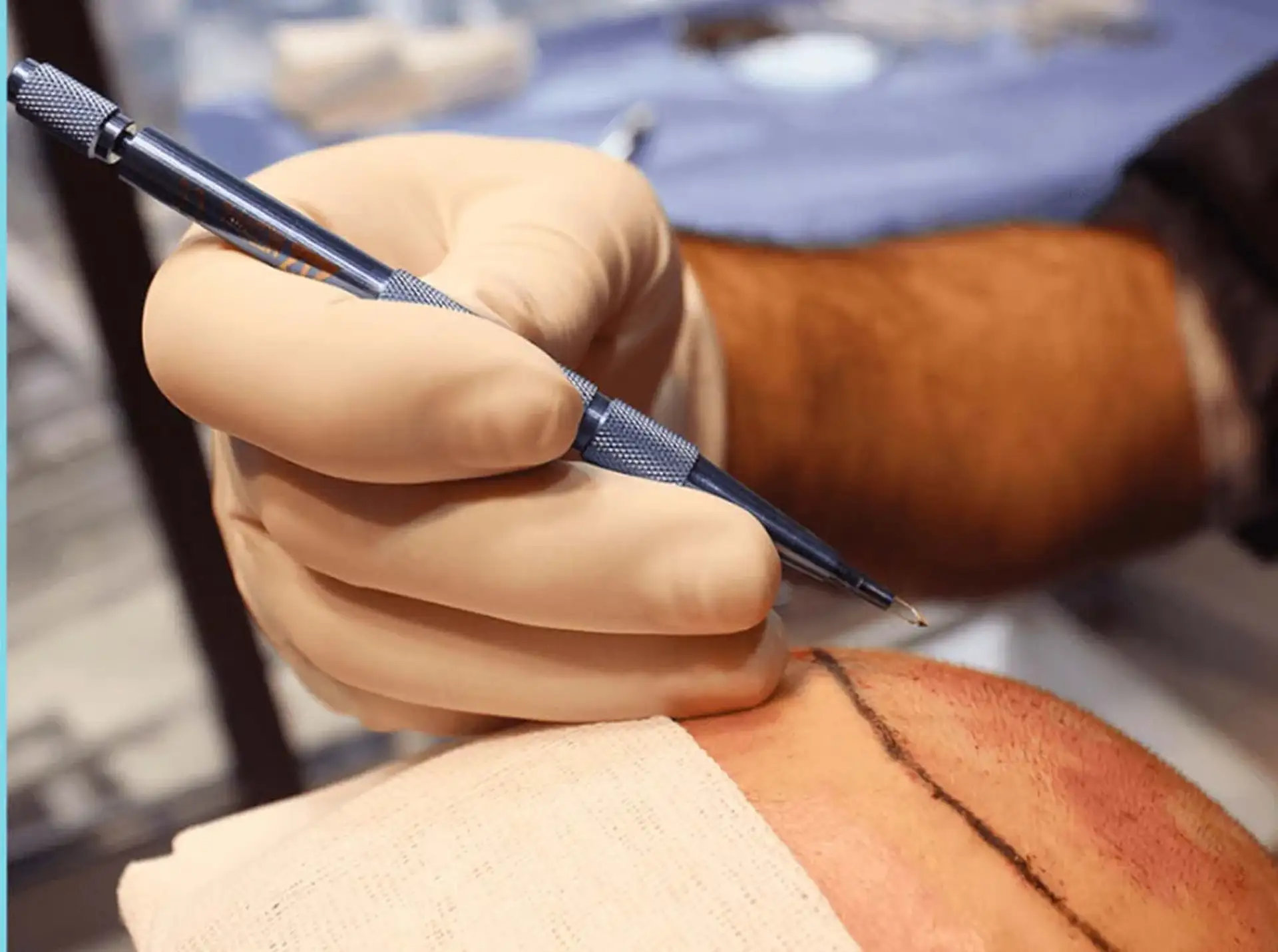 Cost and planning your Sapphire FUE treatment