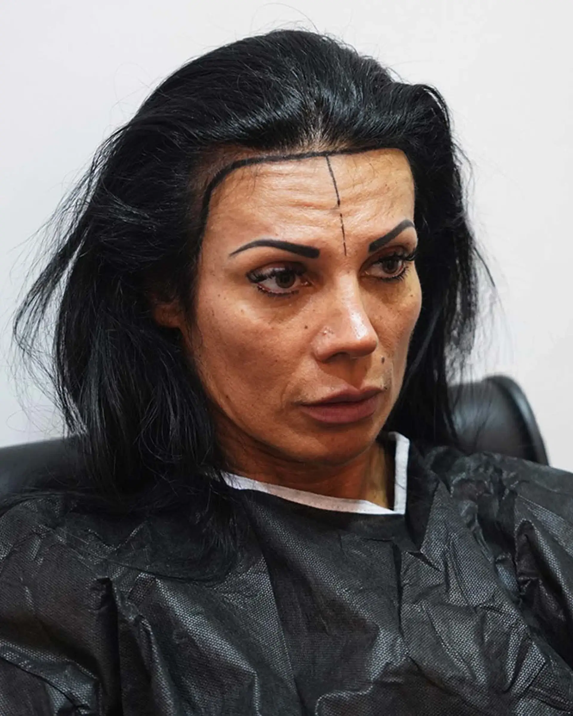 Female Hair Transplant Procedure