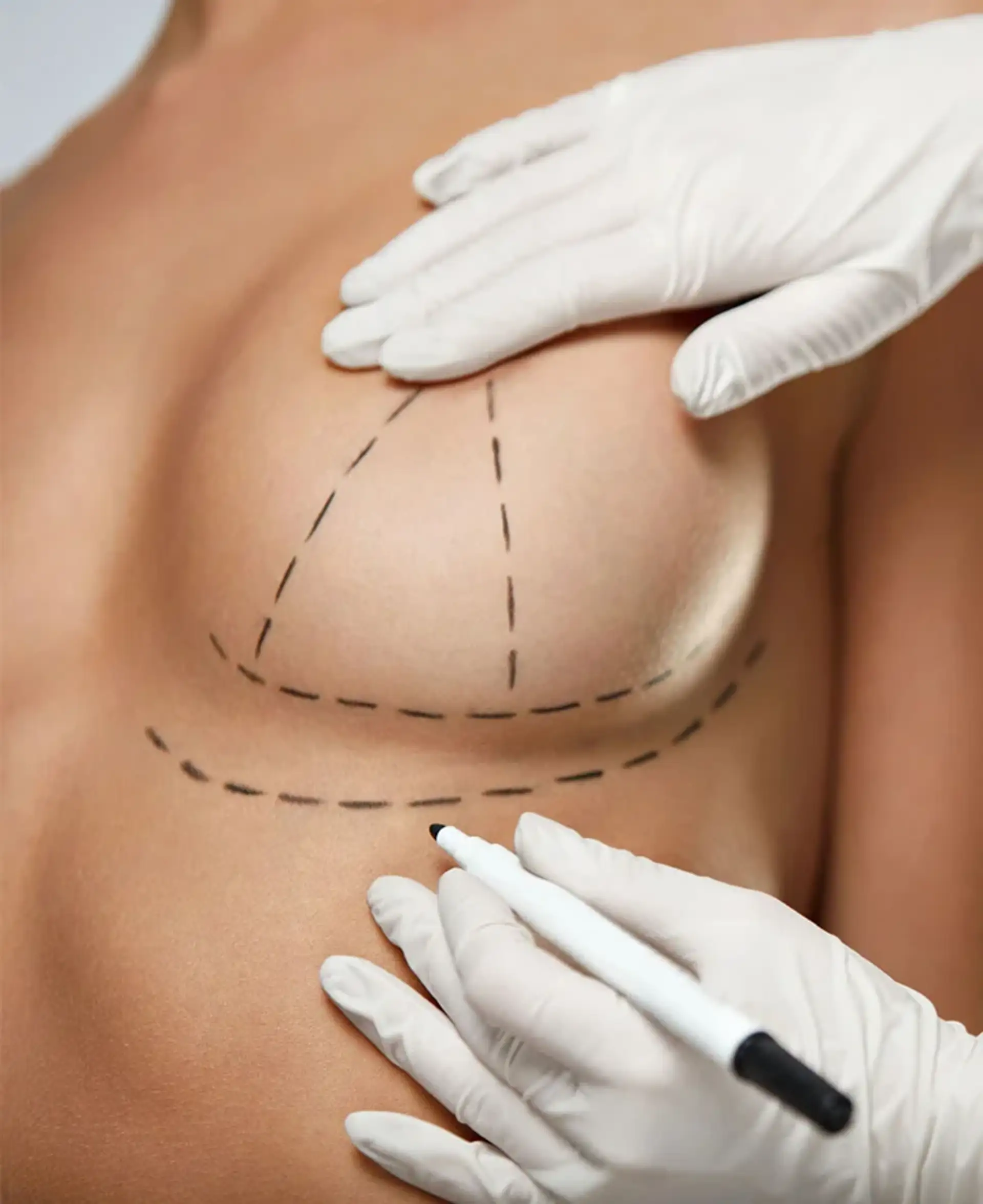 How Is Breast Augmentation Performed?