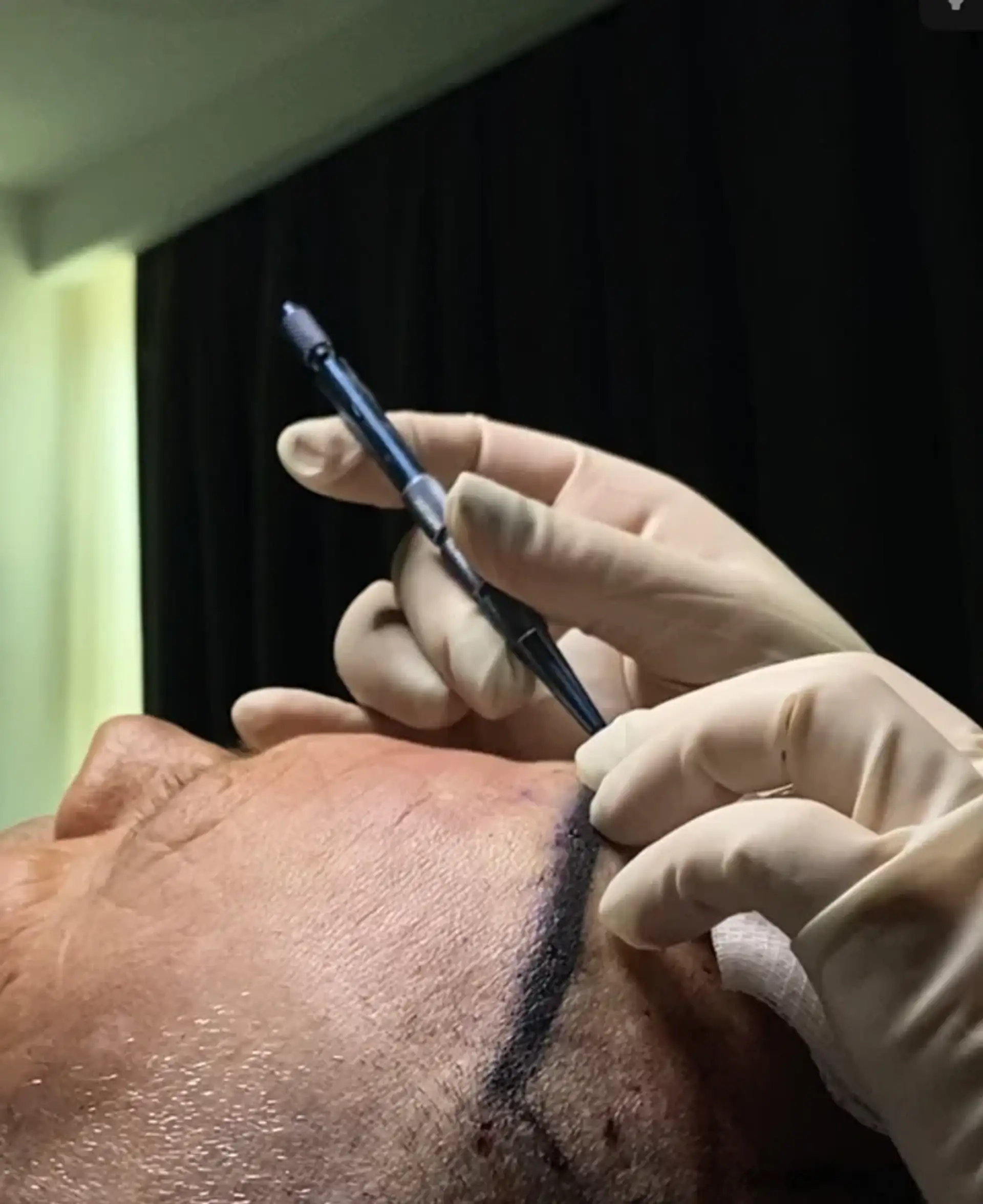 Using FUE Engines for Graft Extraction